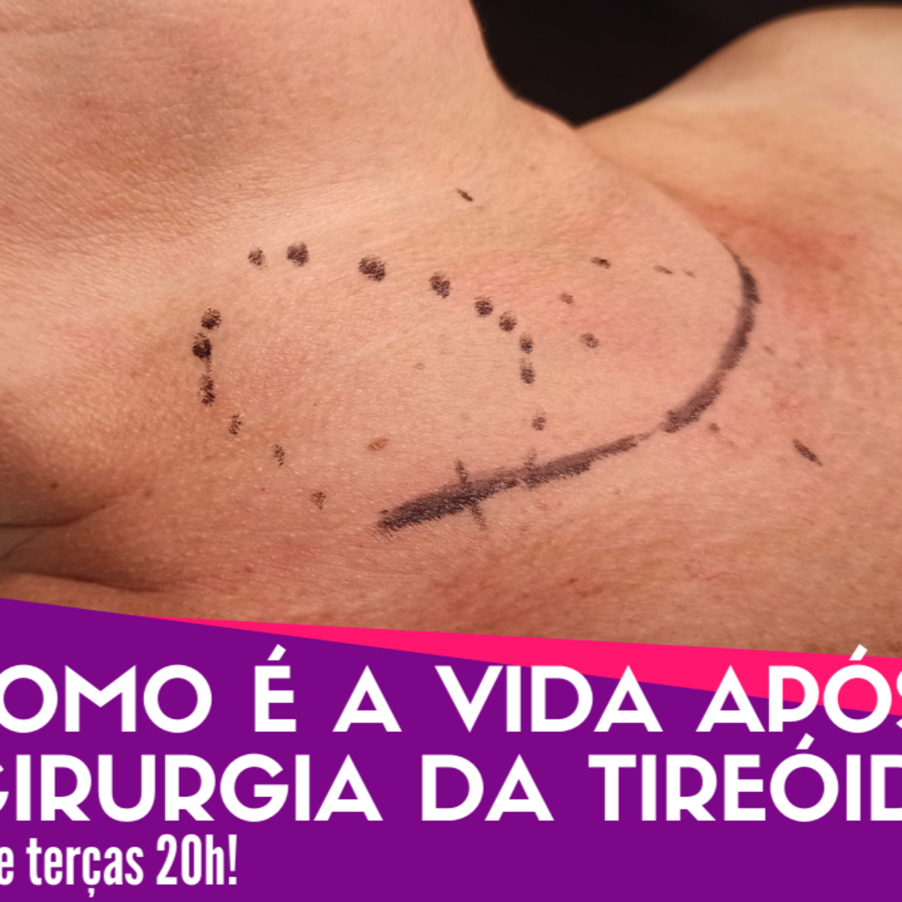 Descomplicando a Tireóide - Dr Jônatas Catunda, cirurgião de cabeça e pescoço