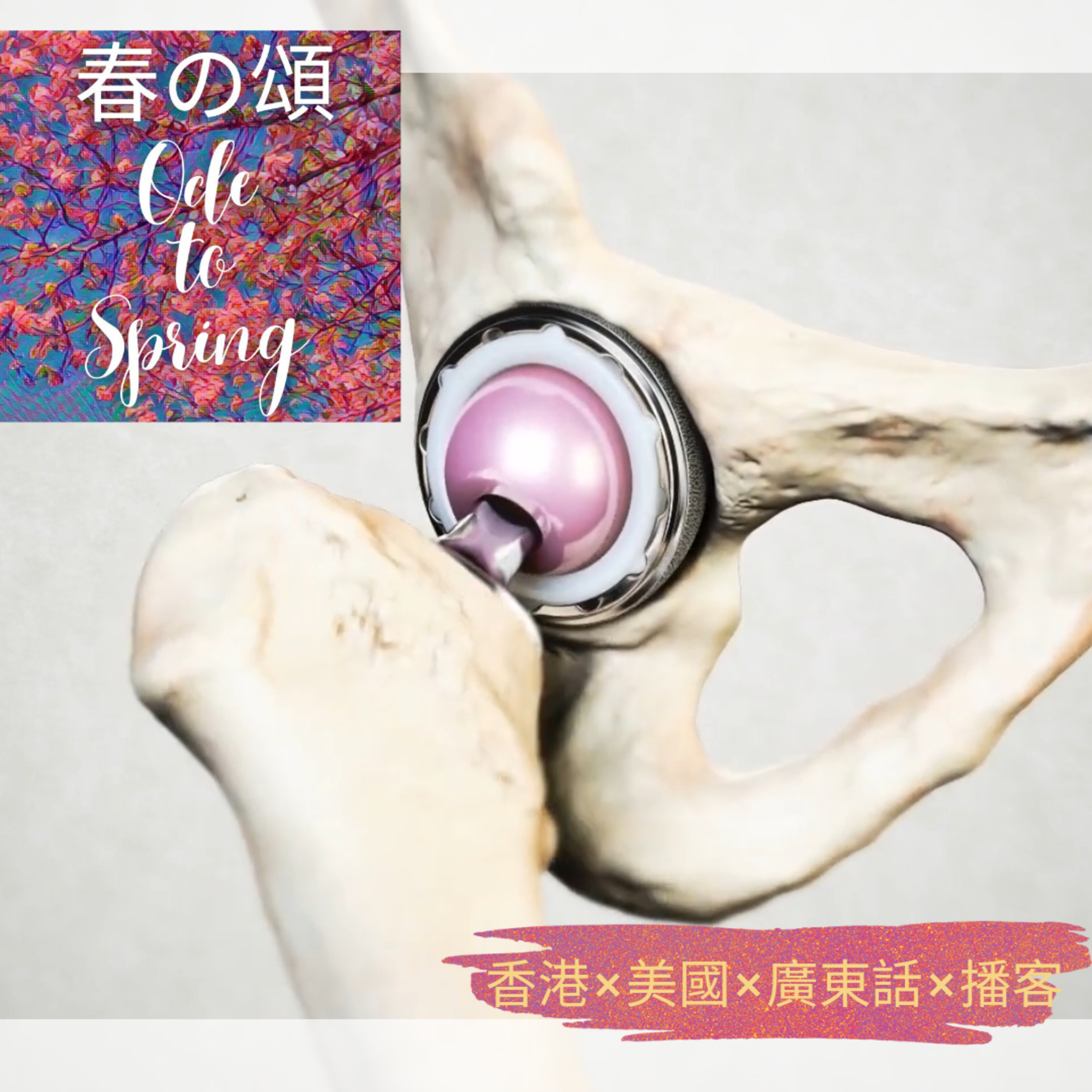 PAO 後做 Total Hip Replacement 前同亞囡難捨難離 episode artwork