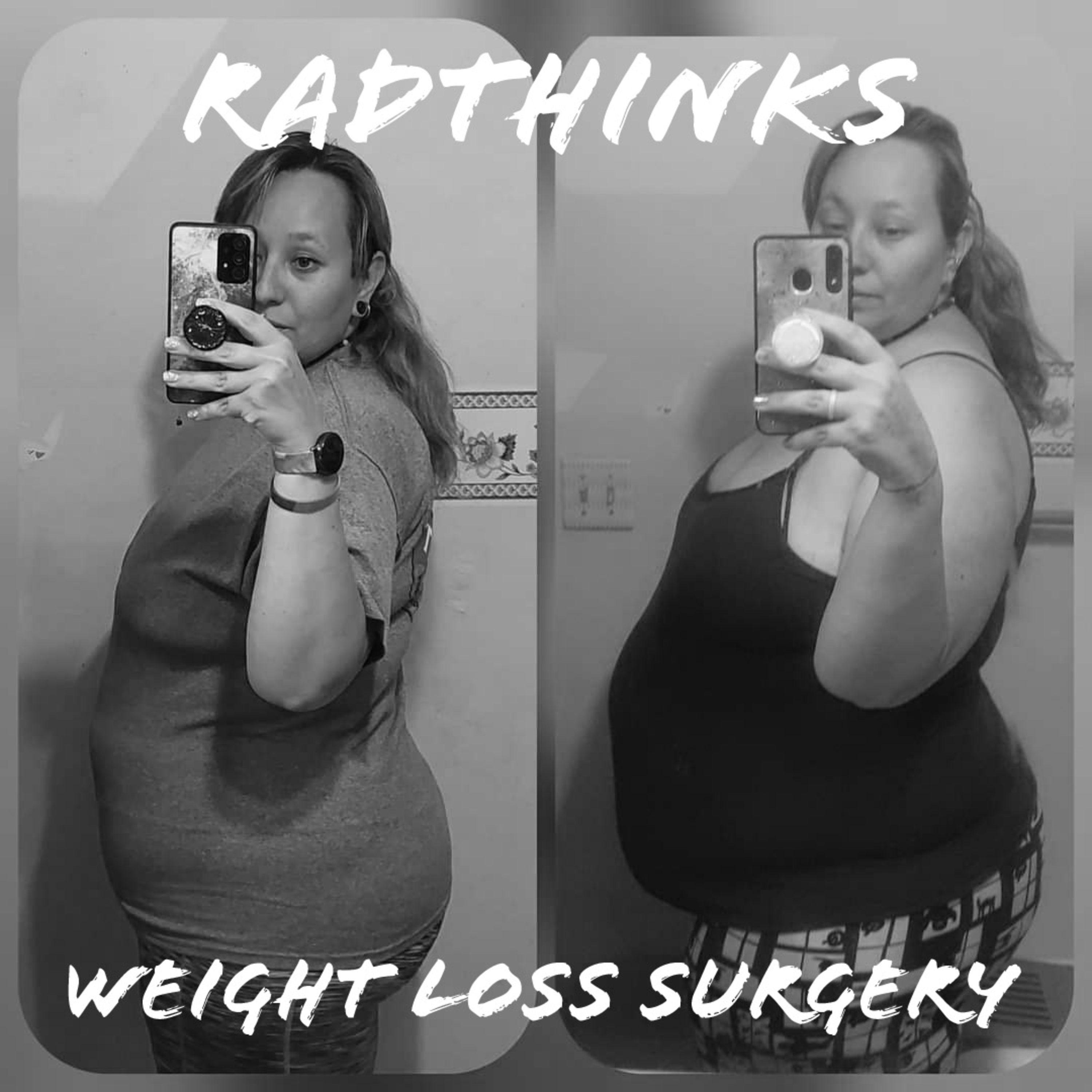 Weight Loss Surgery episode artwork