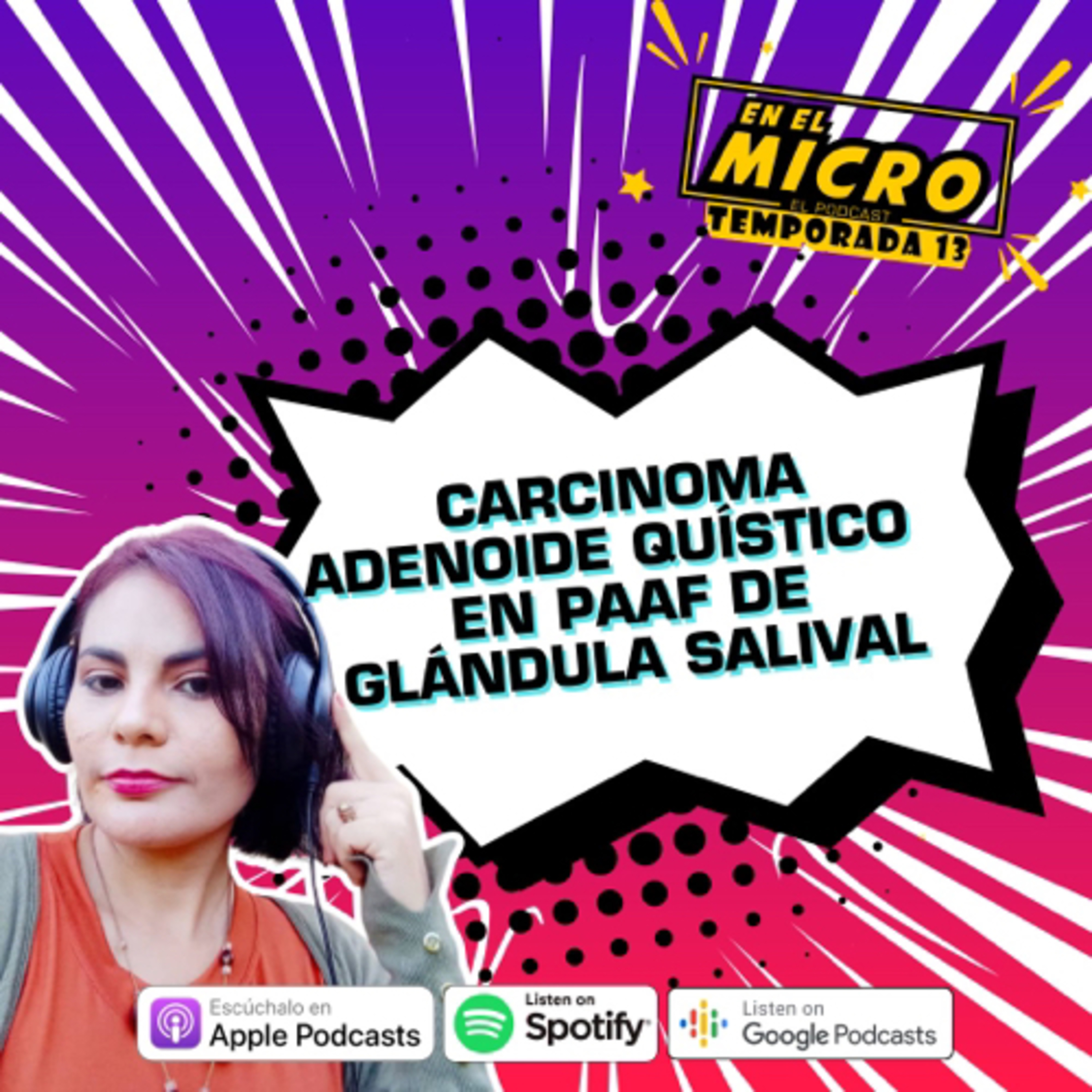 Carcinoma adenoide quístico en PAAF de Glándula Salival