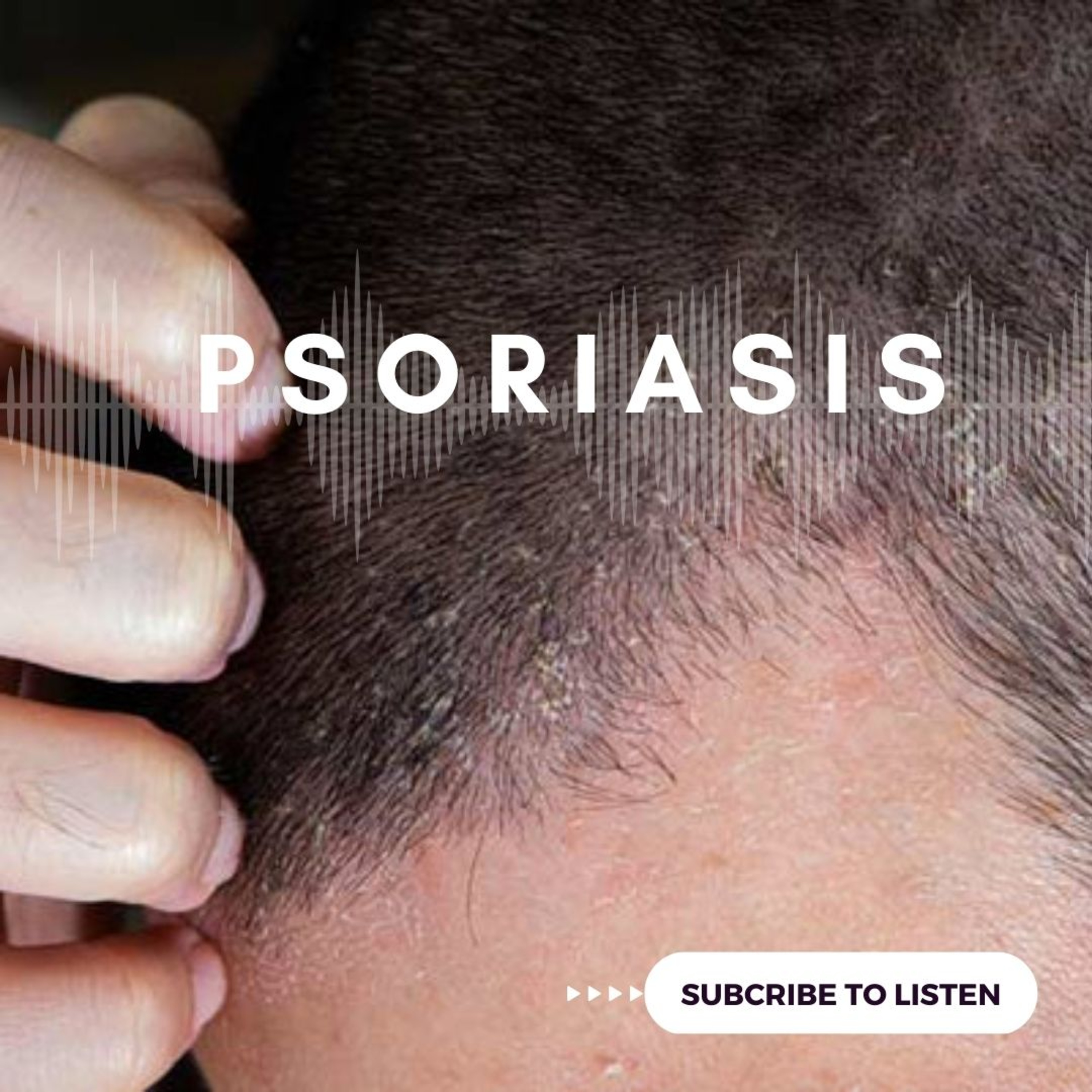 Psoriasis  episode artwork