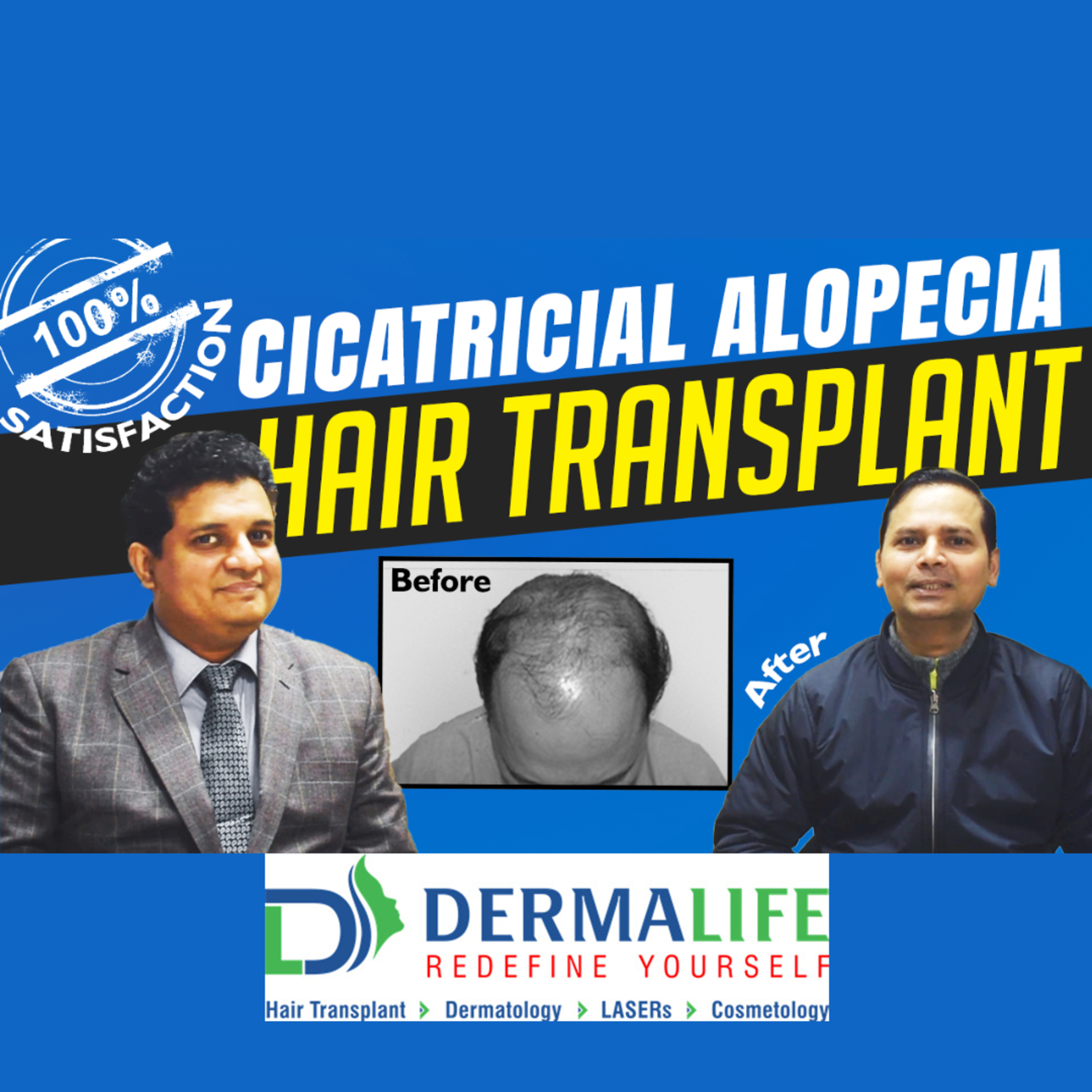 How long does it take to see the result of Hair Transplant.