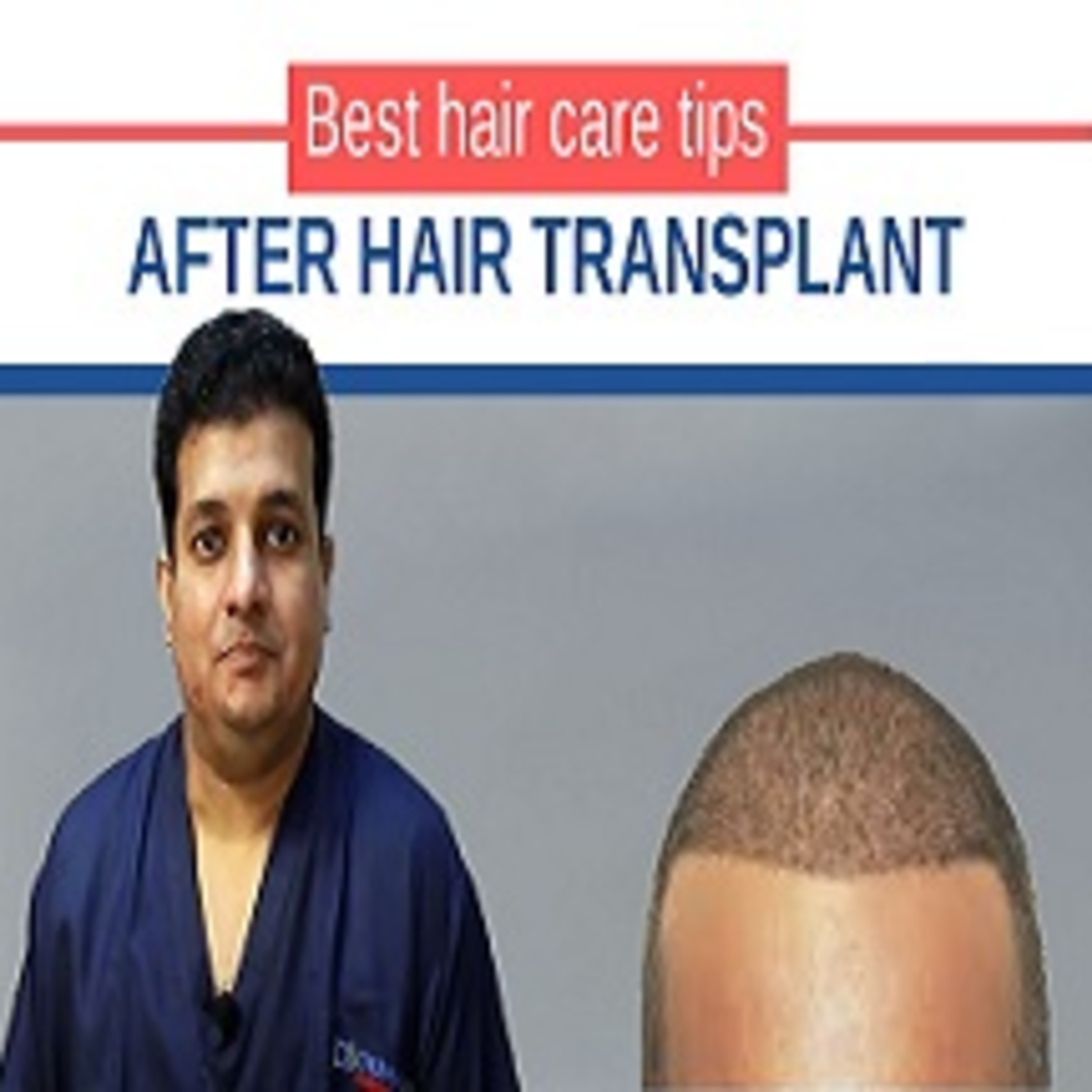 How long does it take to see the result of Hair Transplant.