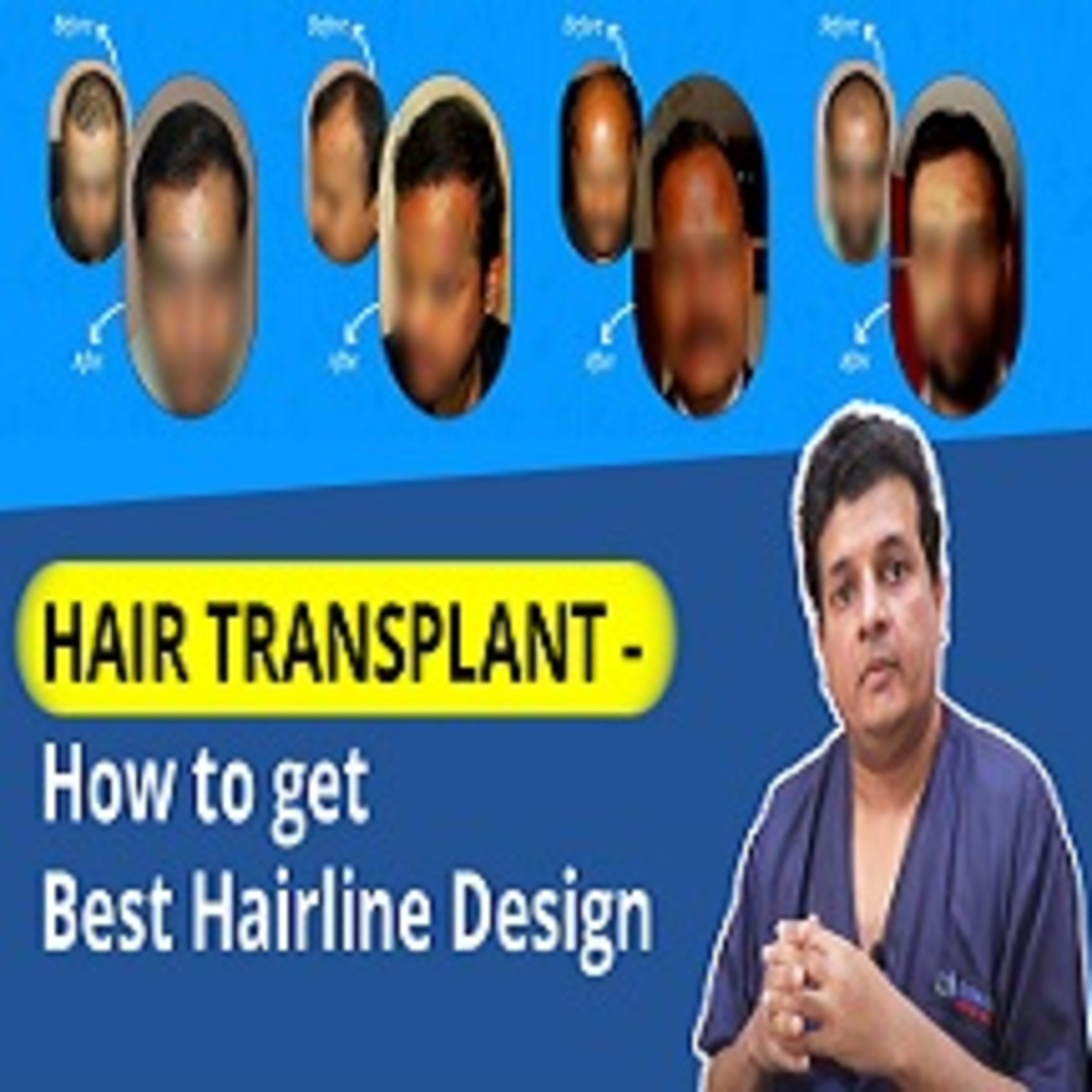 How long does it take to see the result of Hair Transplant.
