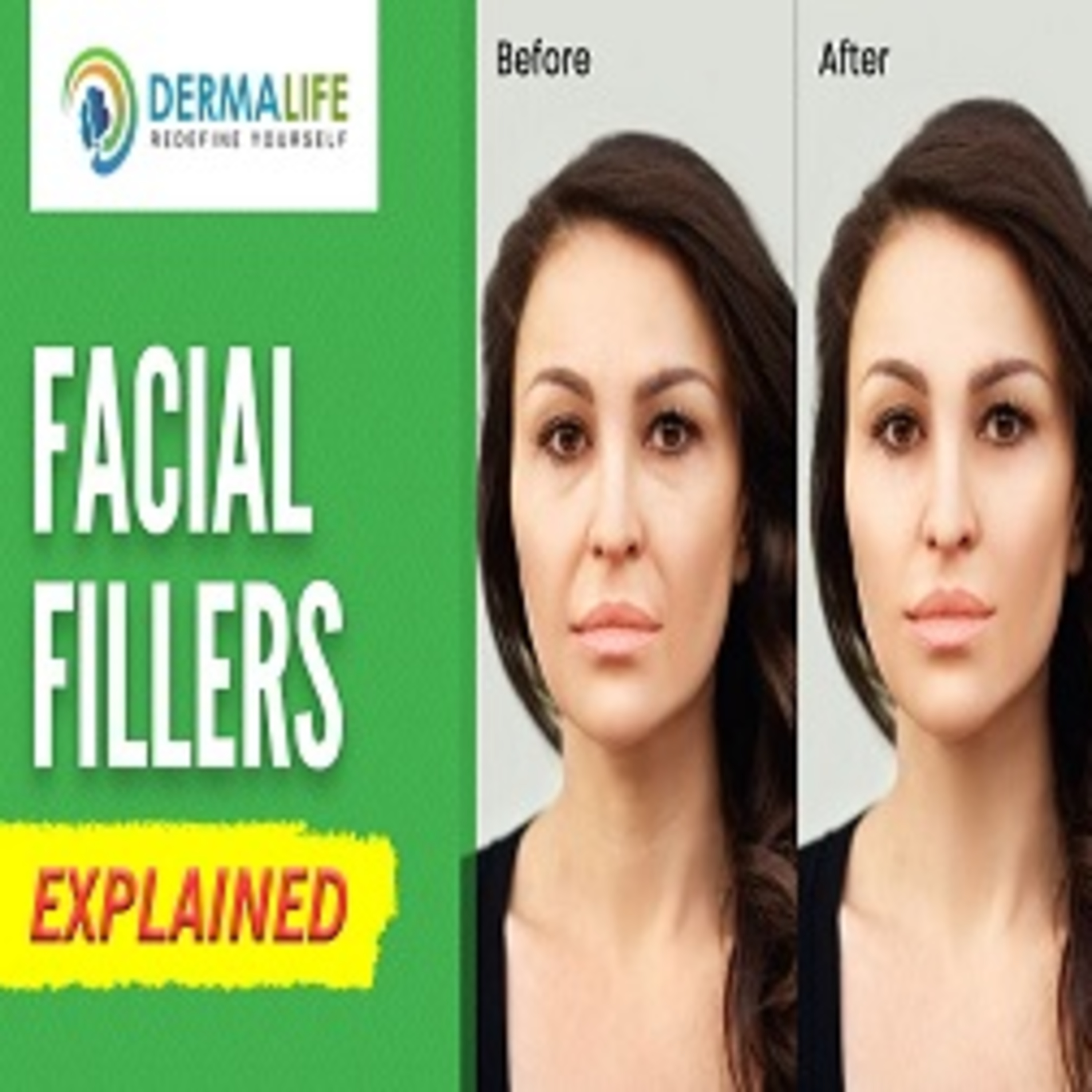How long does it take to see the result of Hair Transplant.