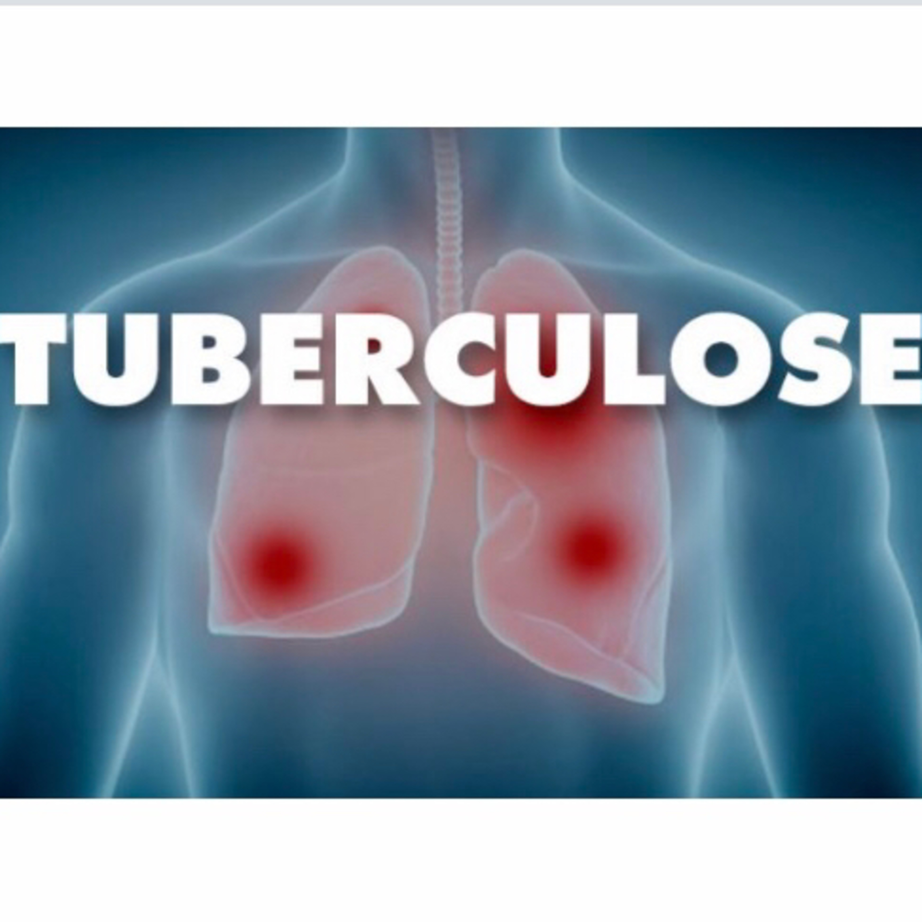 Tuberculose  episode artwork