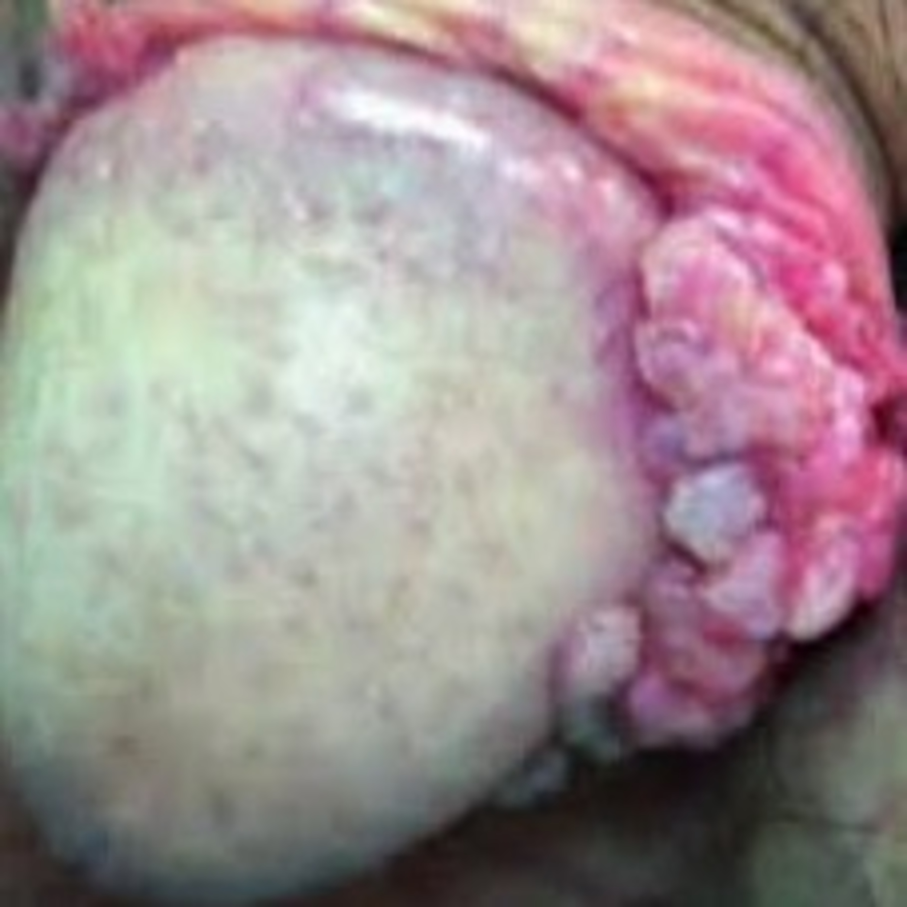 Virus del Papiloma Humano