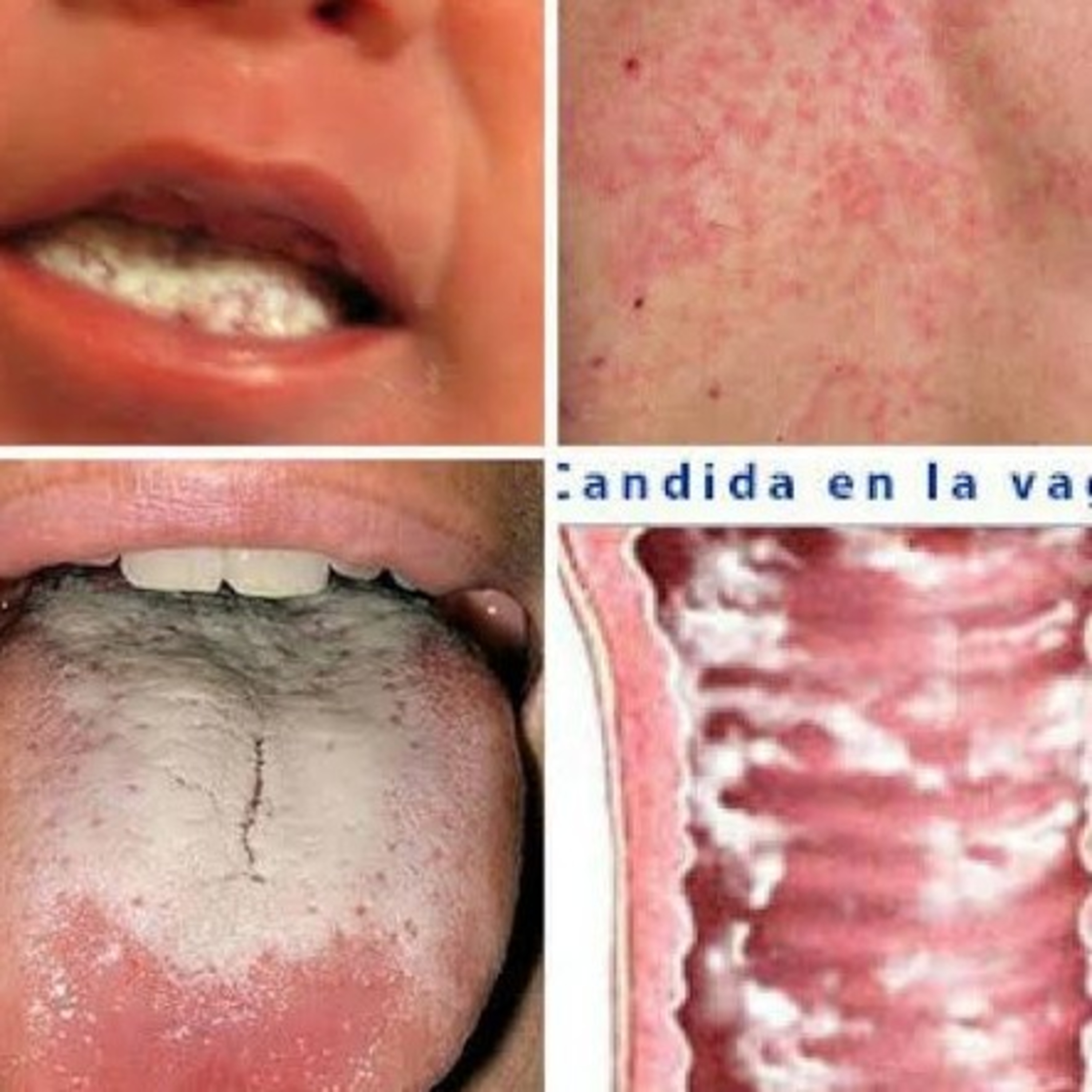 Candidiasis