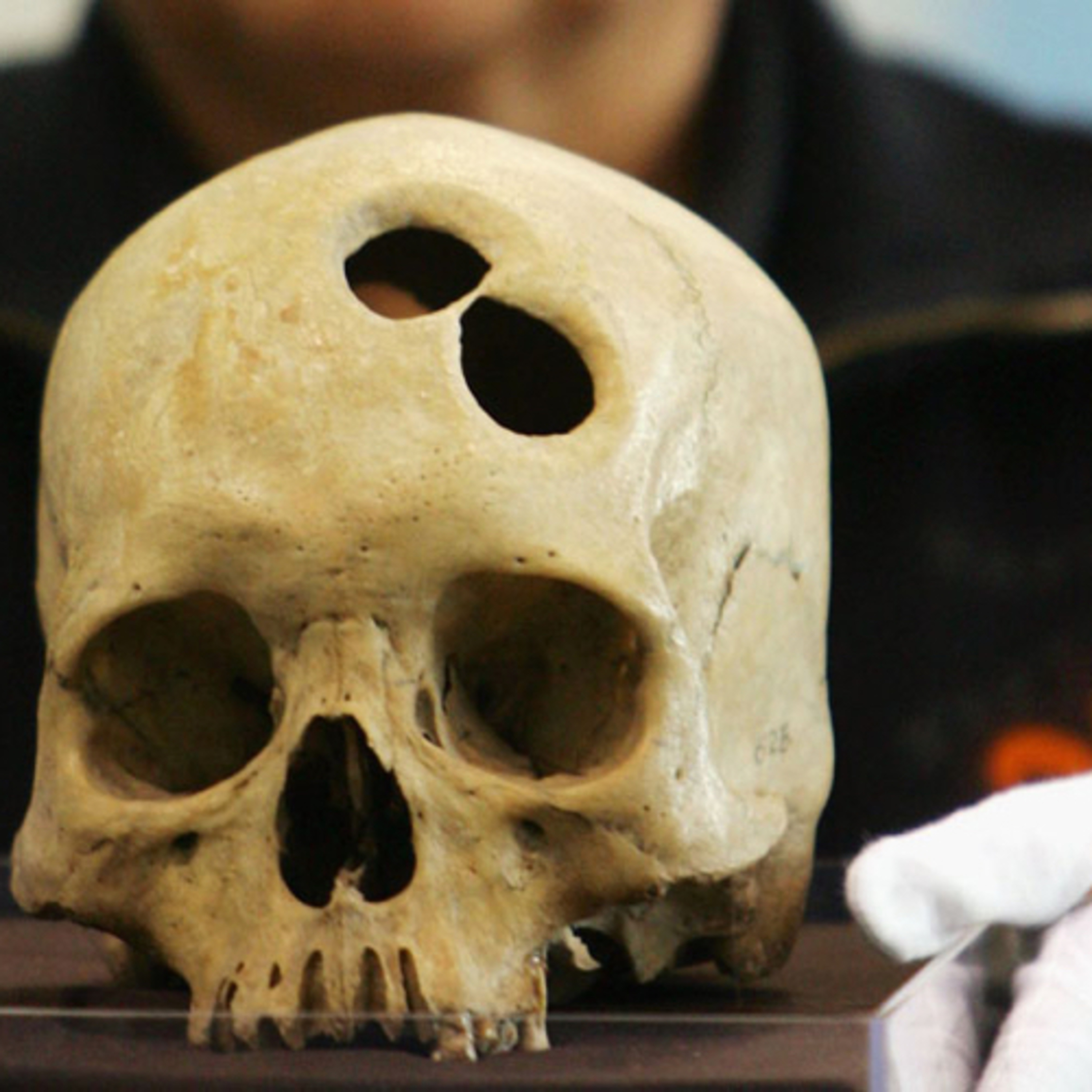 Trepanaciones prehistóricas  episode artwork