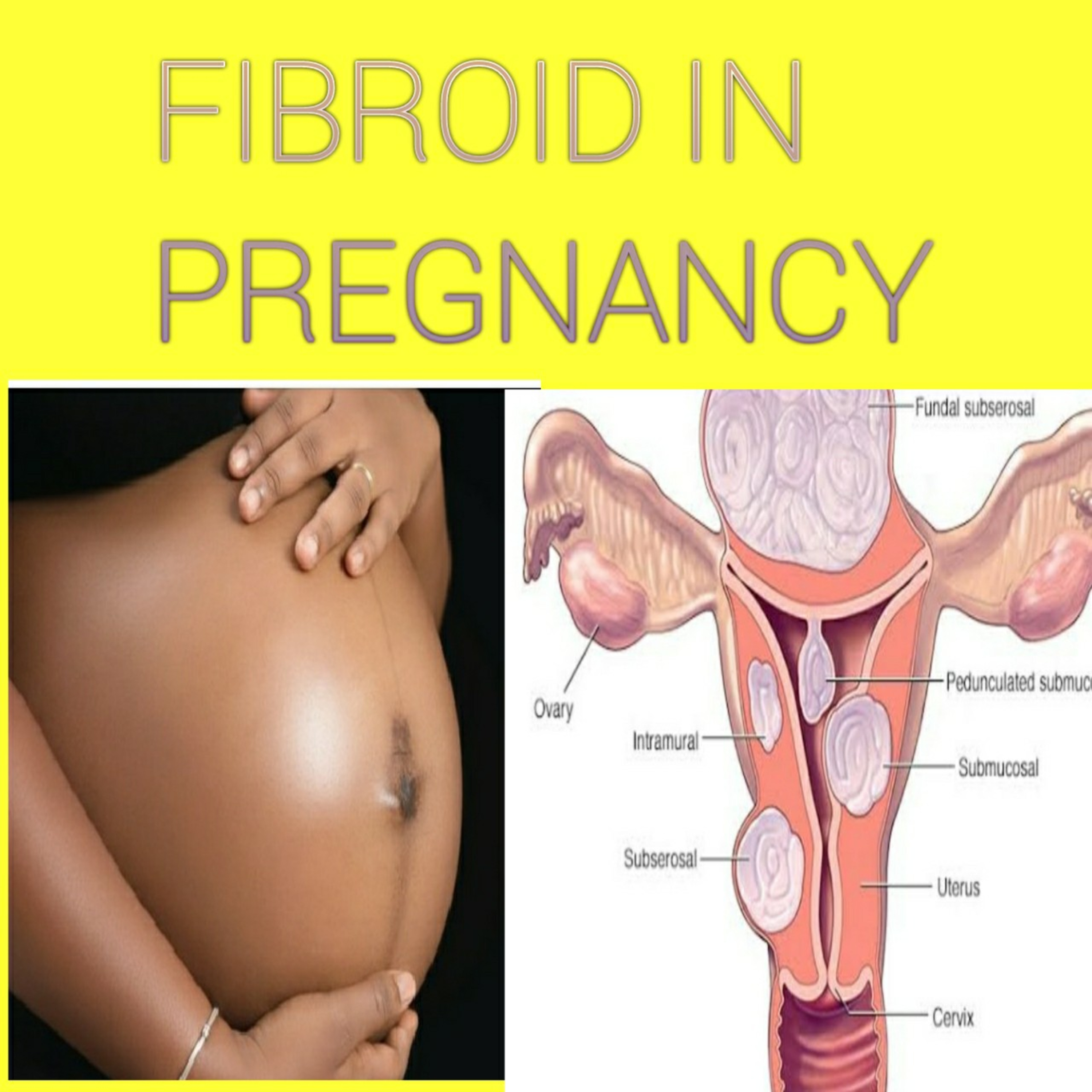 FIBROID IN PREGNANCY LEIOMYOMA TUMORS IN PREGNANCY episode artwork