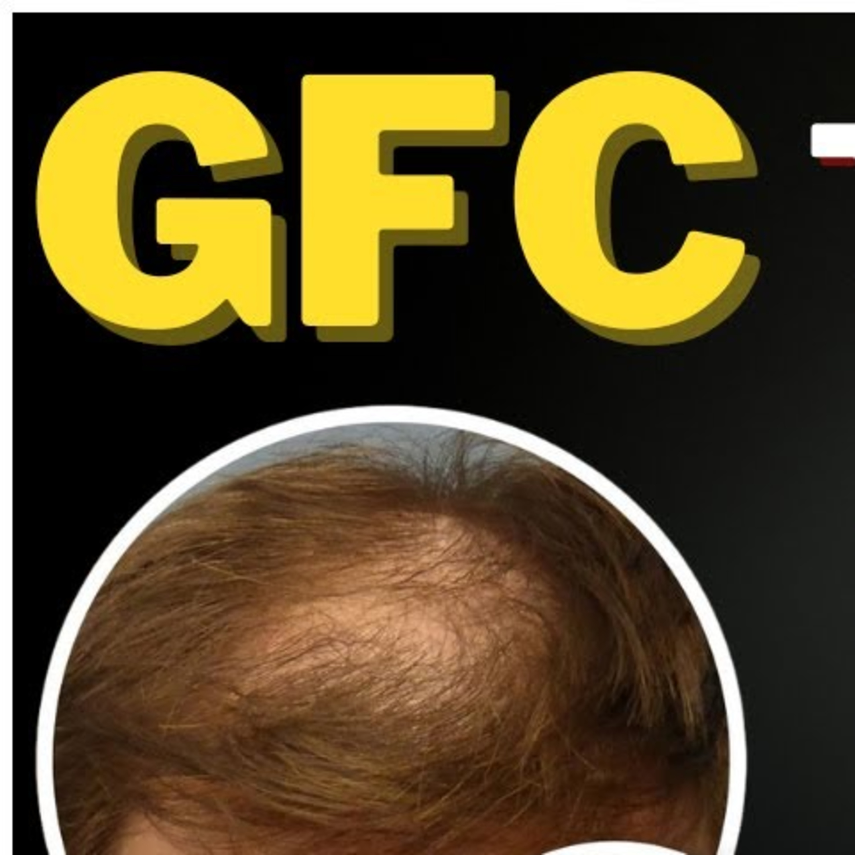 Hair Transplant Podcast - HAIR TALK with Dr.John Watts Hair Transplant Surgeon and Dermatologist