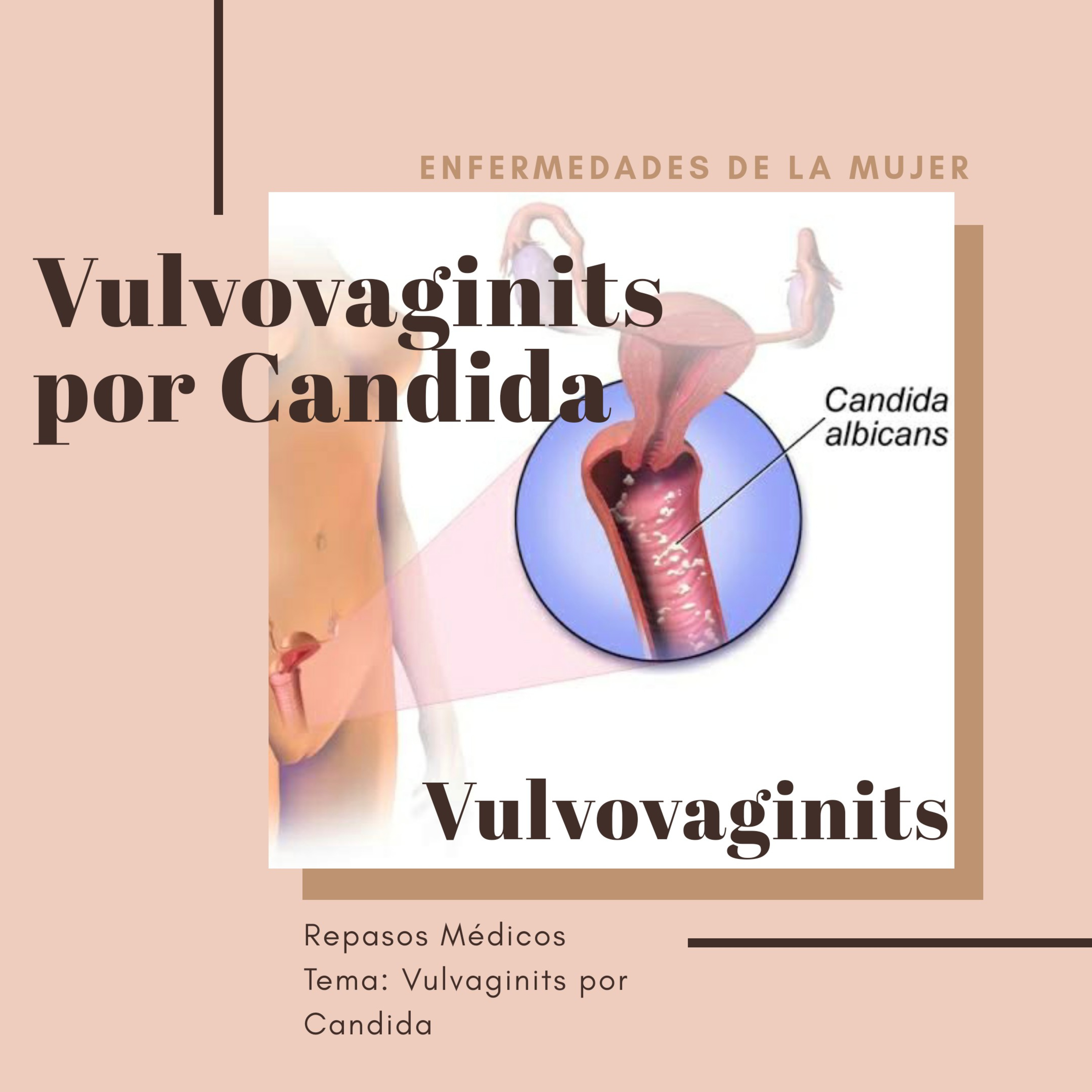 Vulvovagintis episode artwork