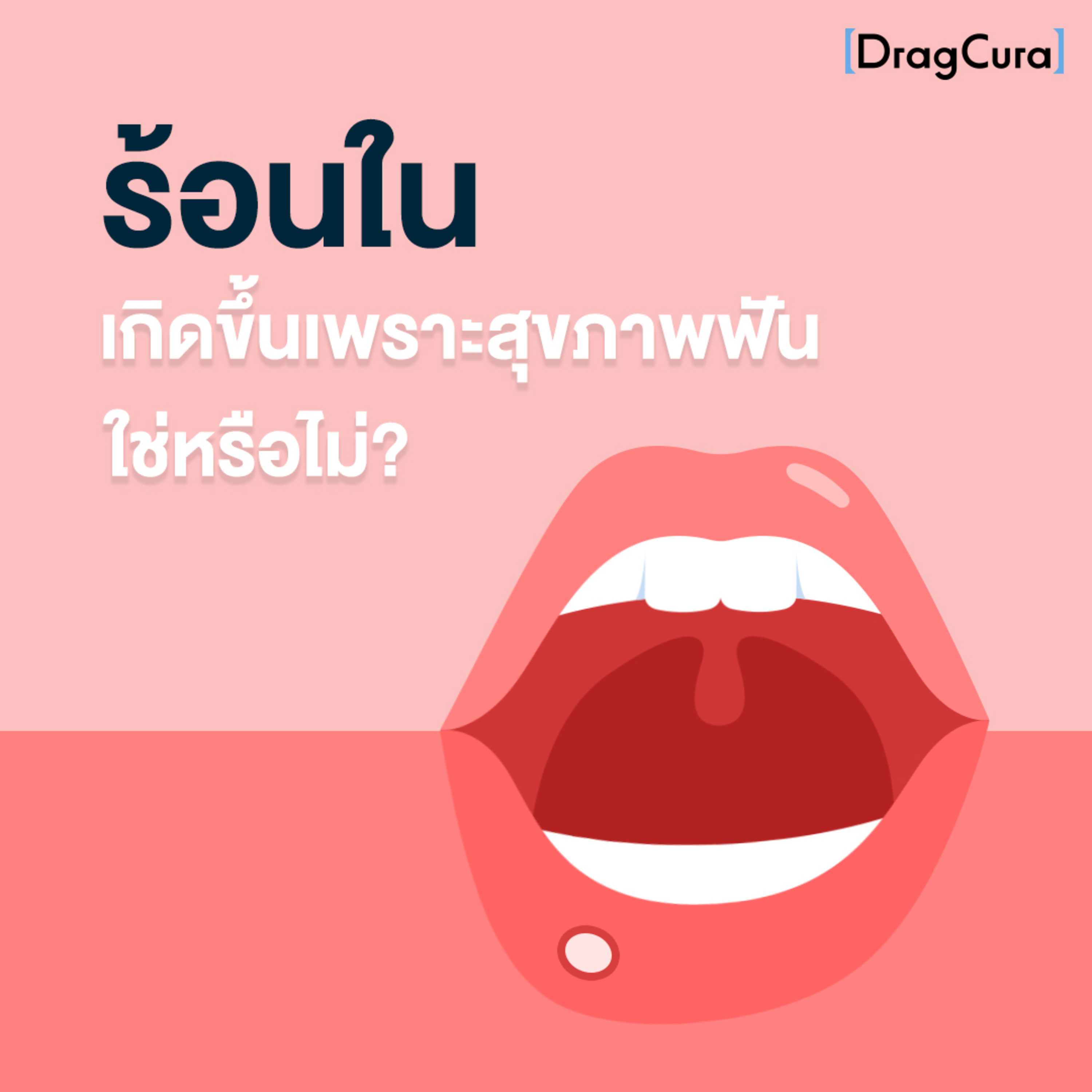 ร้อนใน เกิดขึ้นเพราะสุขภาพฟันใช่หรือไม่? [EP.27] - DragCura Podcast