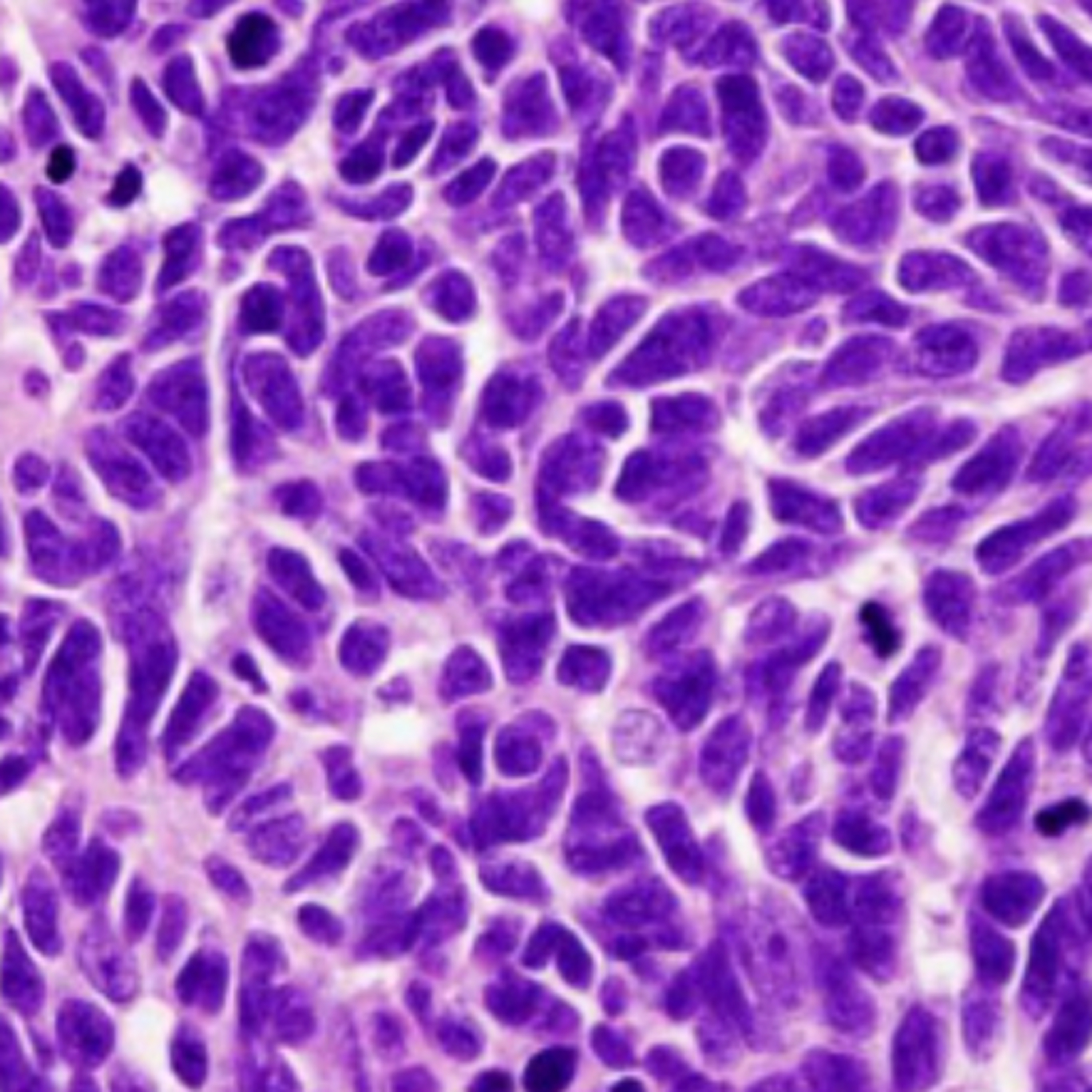 HY USMLE Q #685 – Pulmonary
