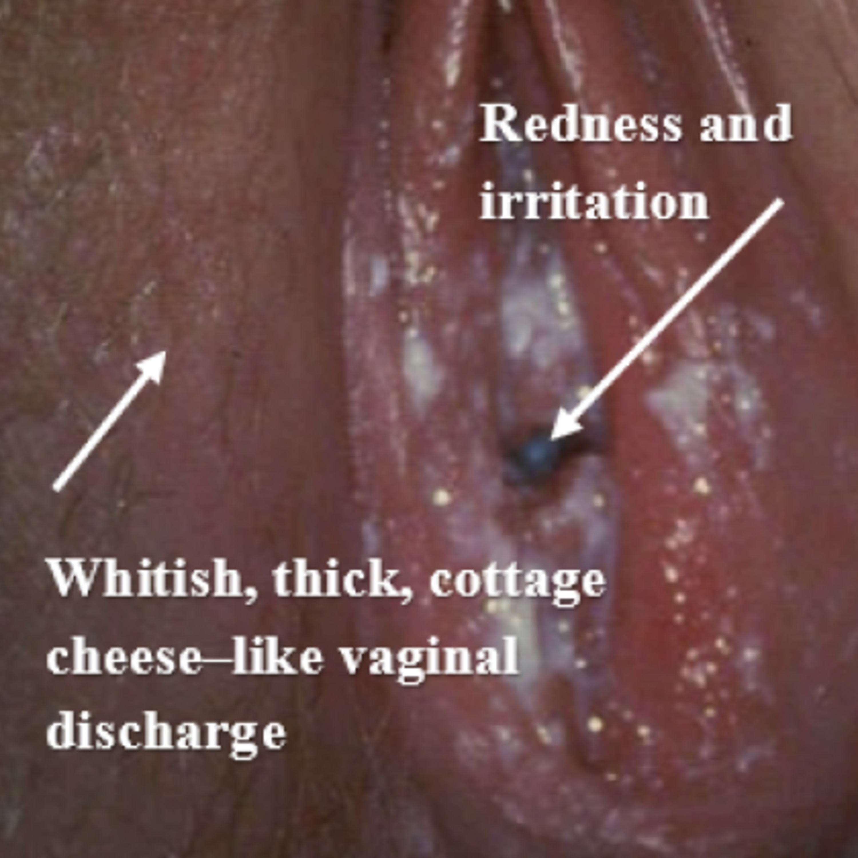 ARE YOU STRUGGLING WITH YEAST INFECTION??!! THIS EPISODE IS FOR YOU episode artwork