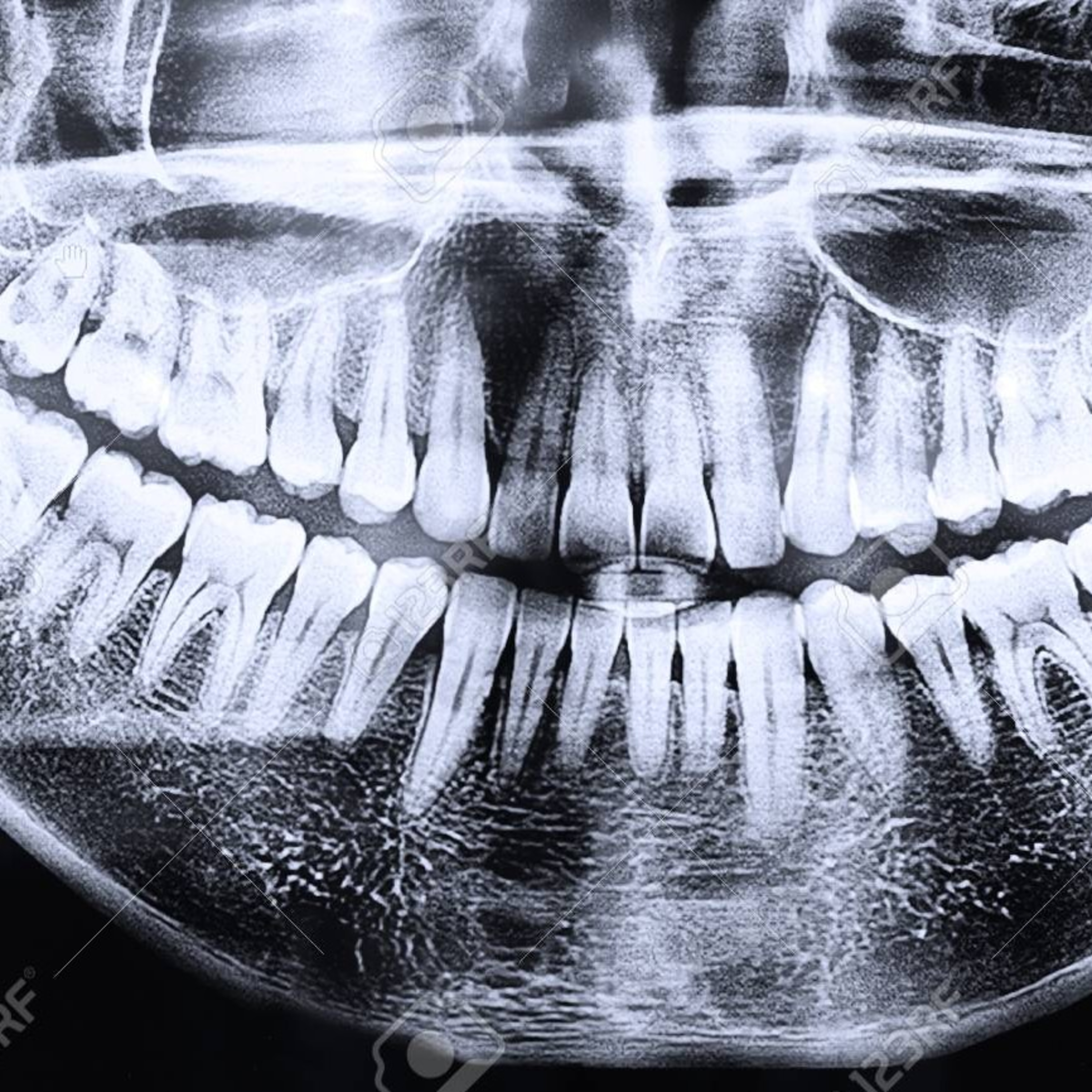 Revelado o procesado de la radiografía dental 