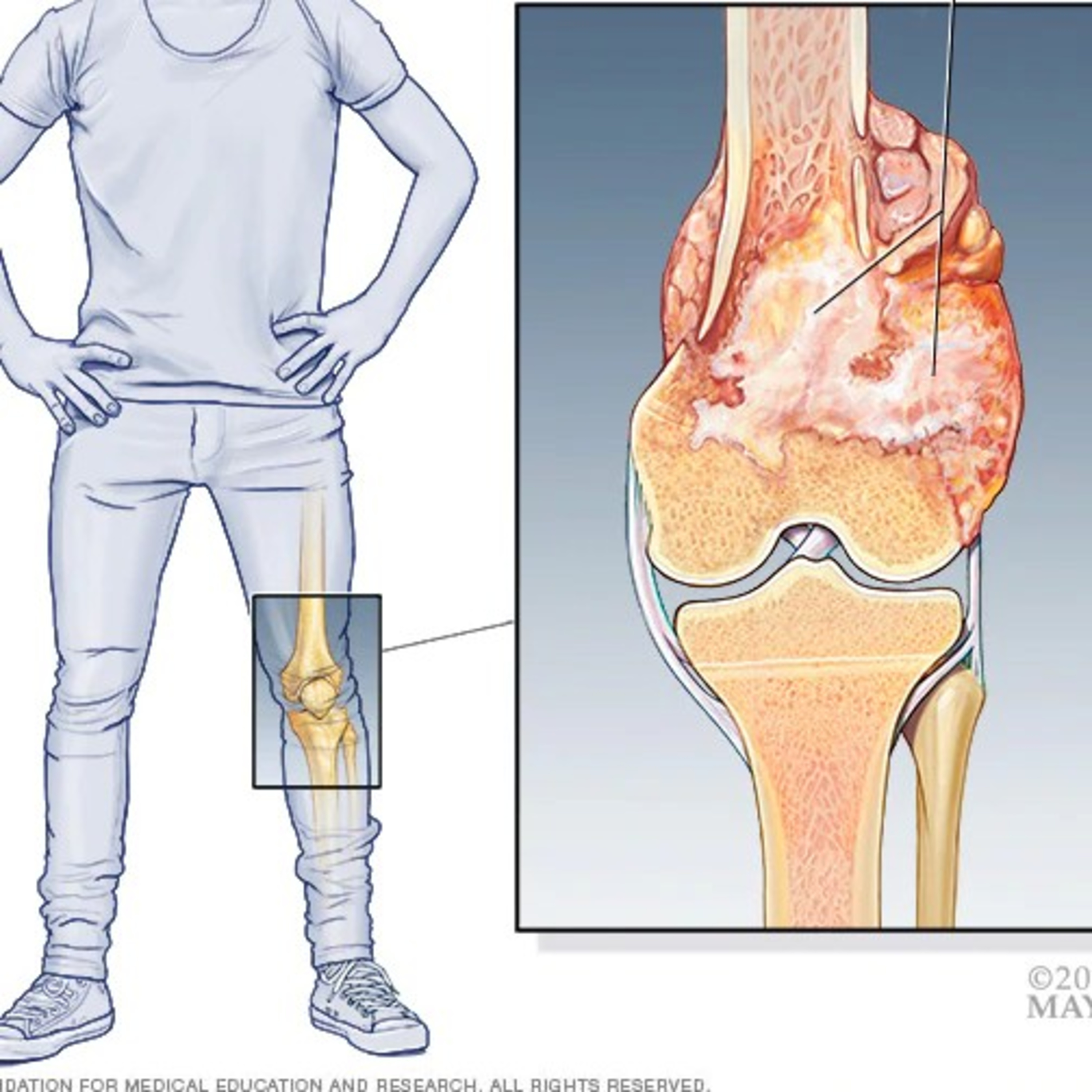 Found out that I have a diagnosis of bone cancer.  episode artwork