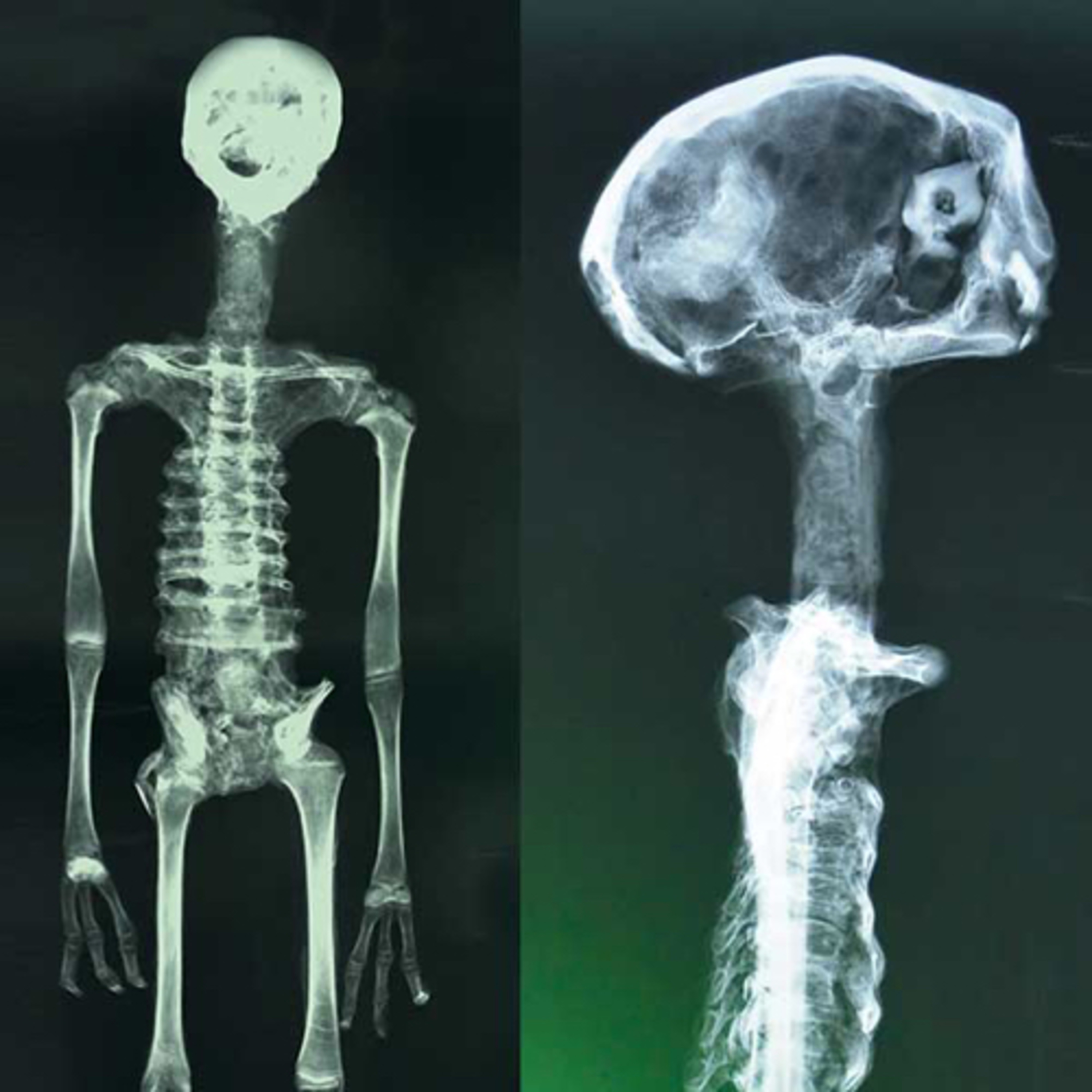 Peruvian Alien Mummies: Paracas Skulls, Starchild Skull, and The Dark Ages of Ufology