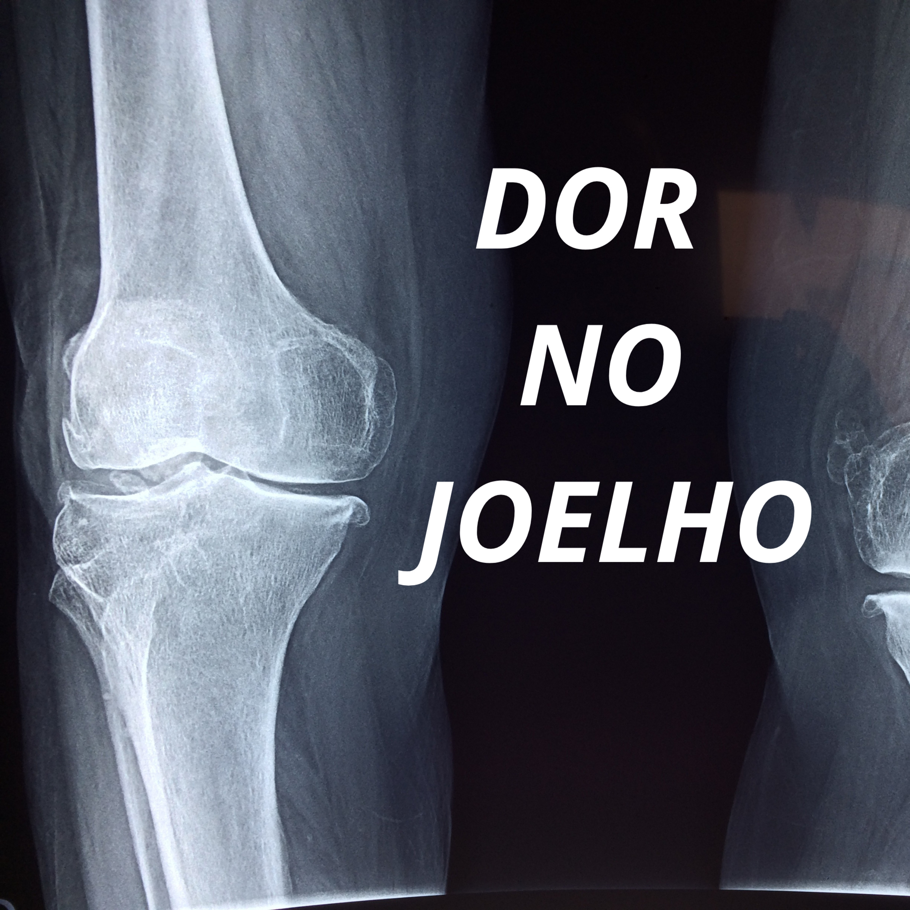 Dor no joelho dos corredores