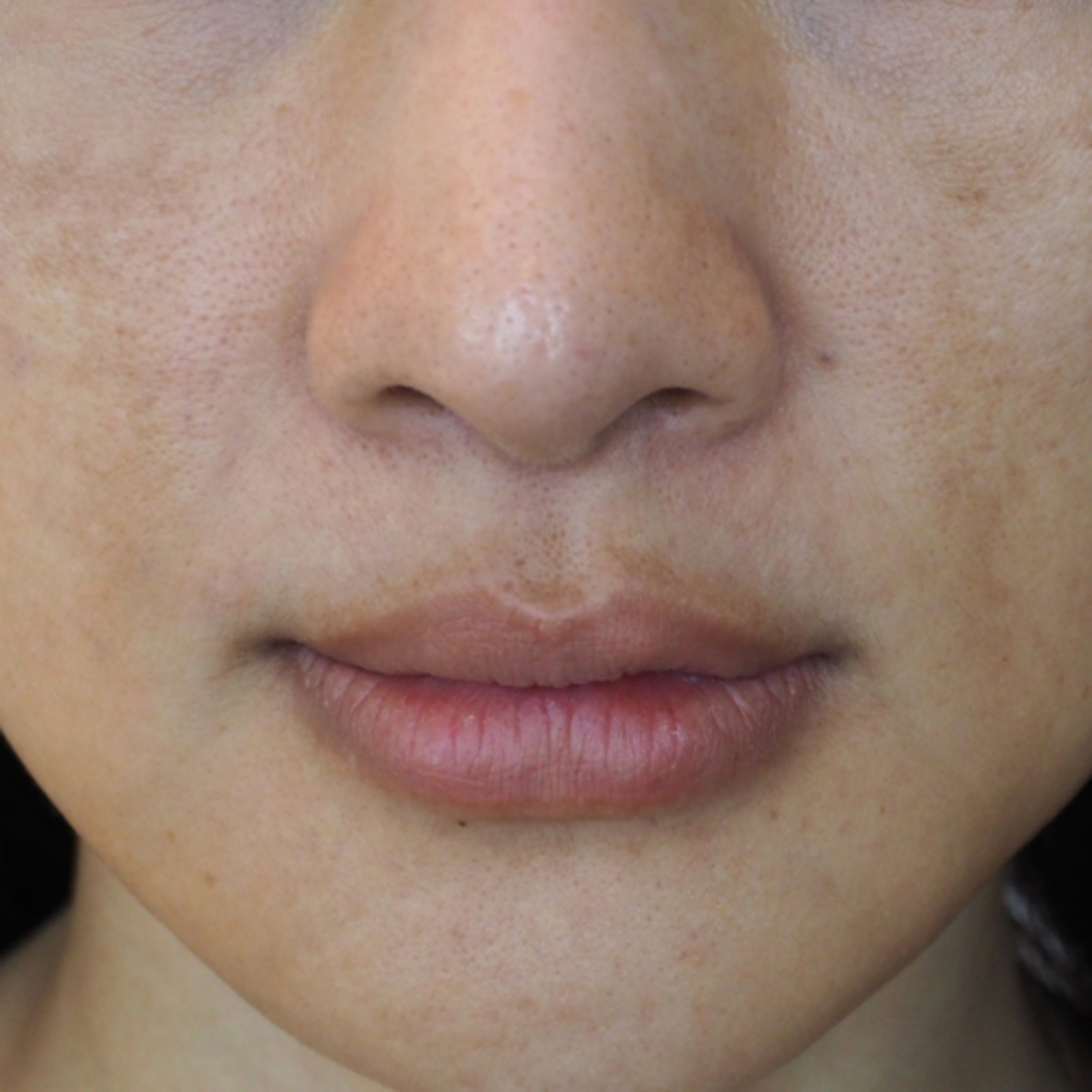 Melasma episode artwork