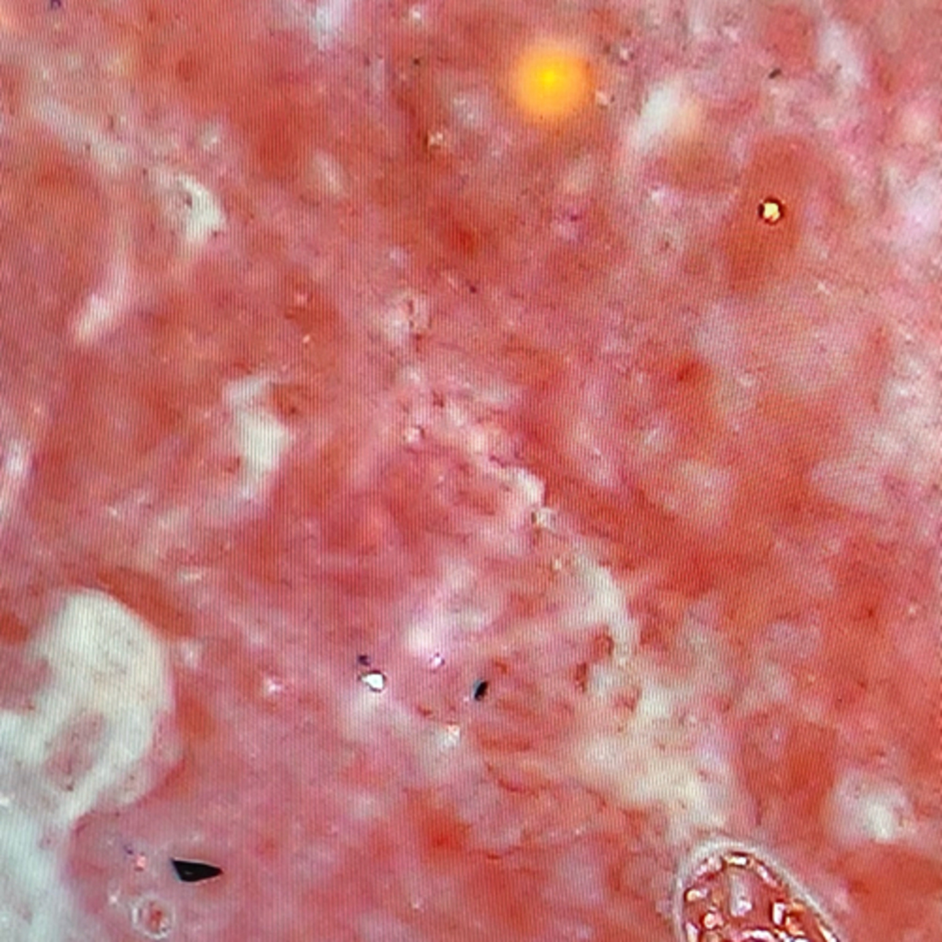 Morgellons Among Us