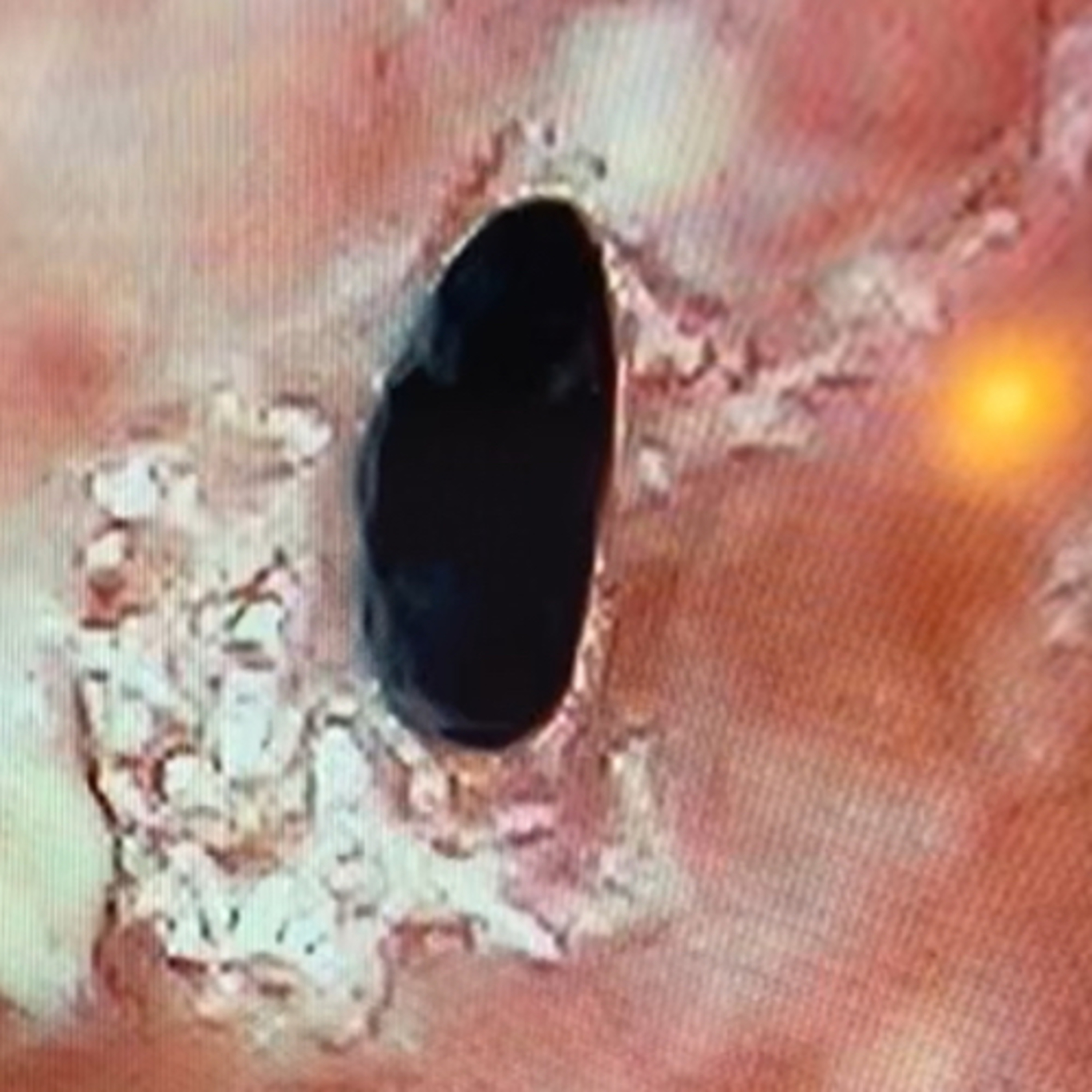 Morgellons Dry with Twist of Lyme