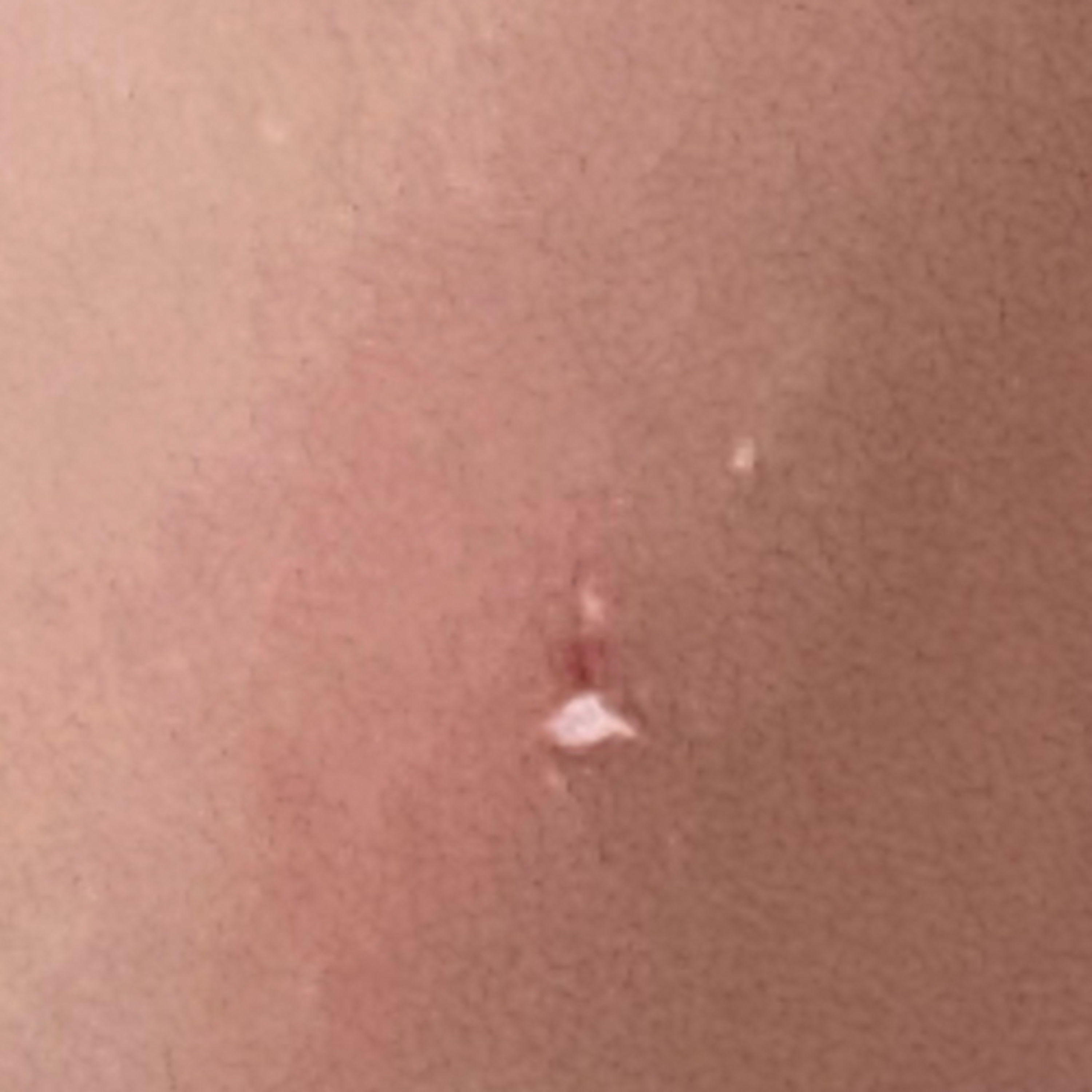 Worms In the Face