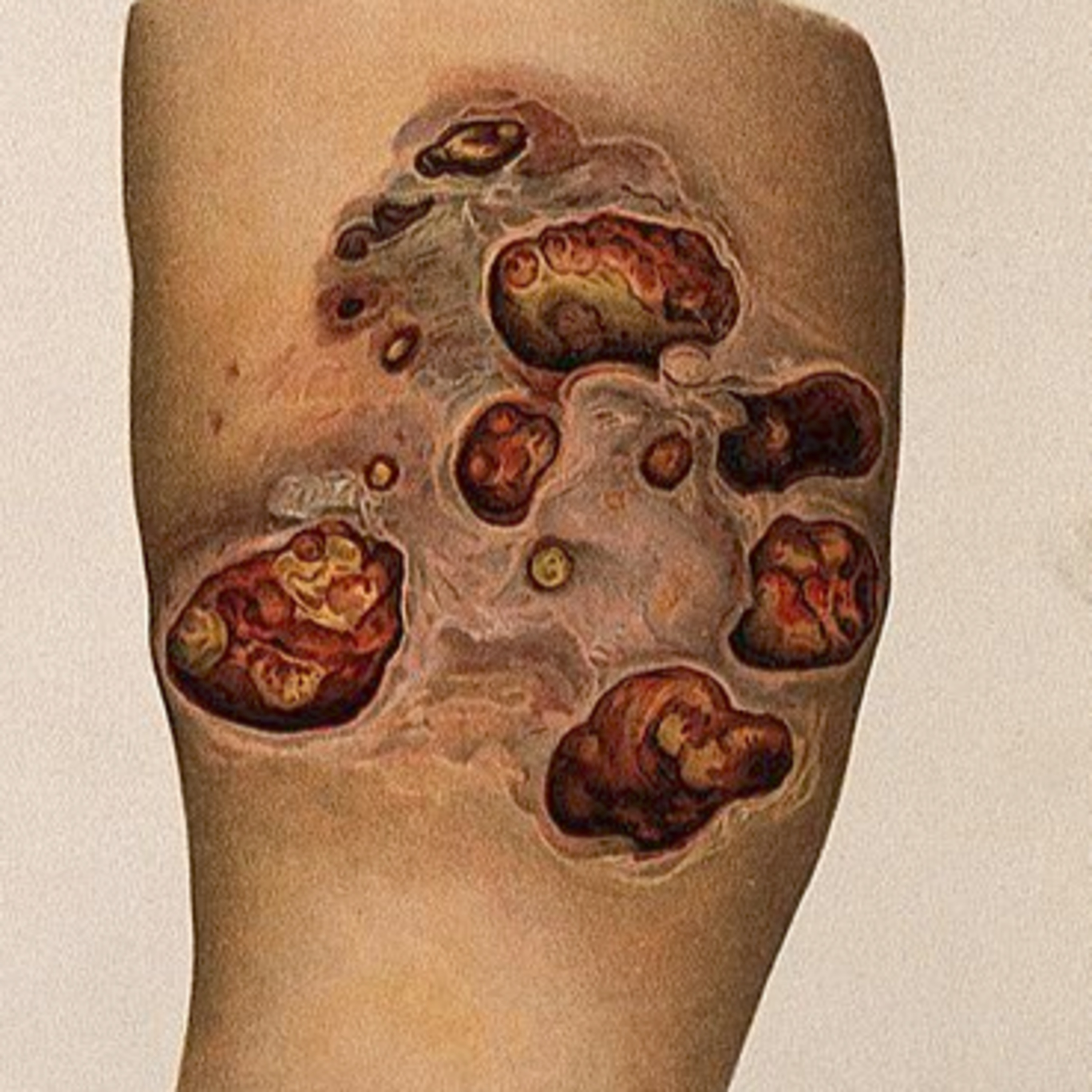 Morgellons Discussion