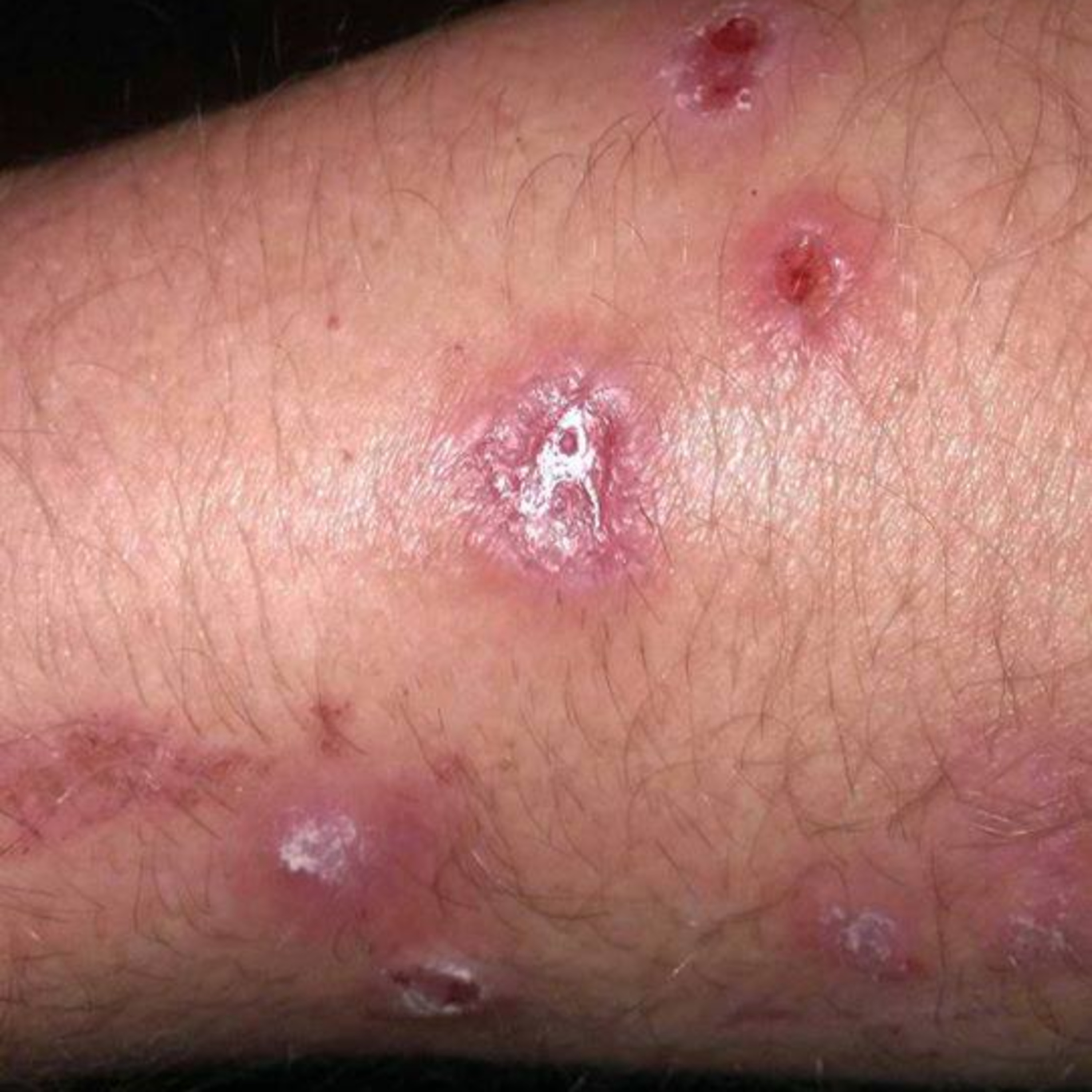 Morgellons Discussion