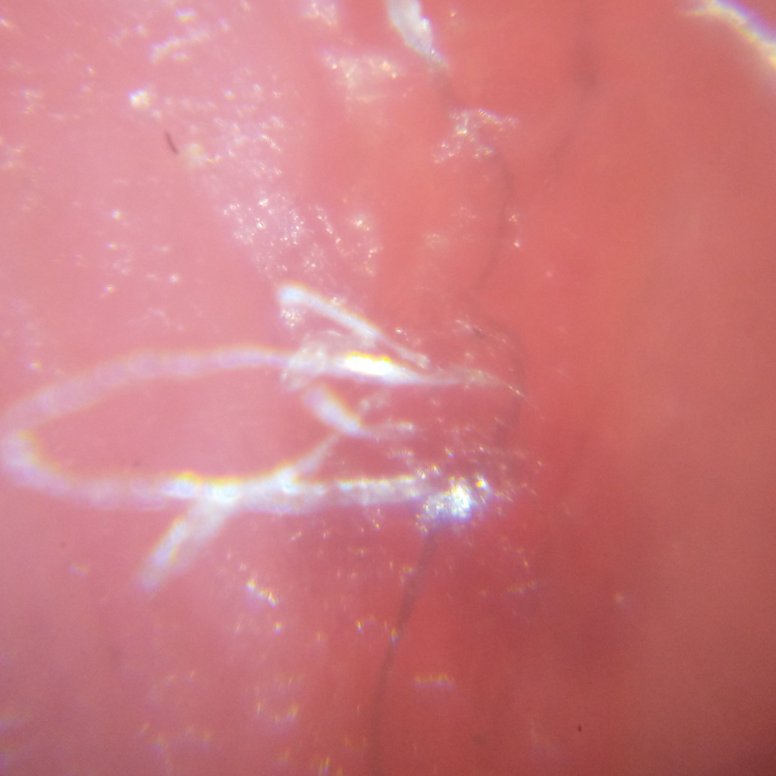 Morgellons Discussion