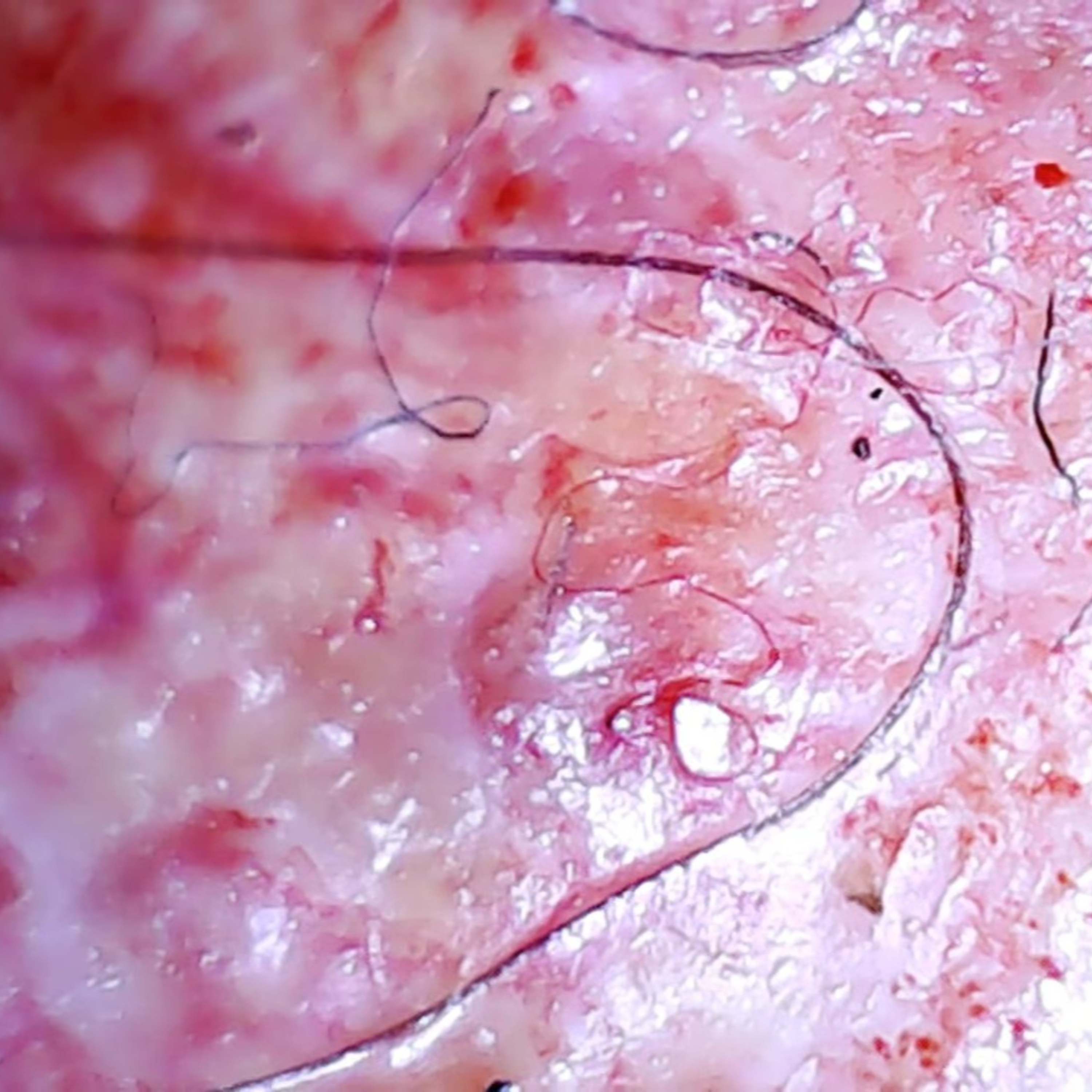 Morgellons Discussion