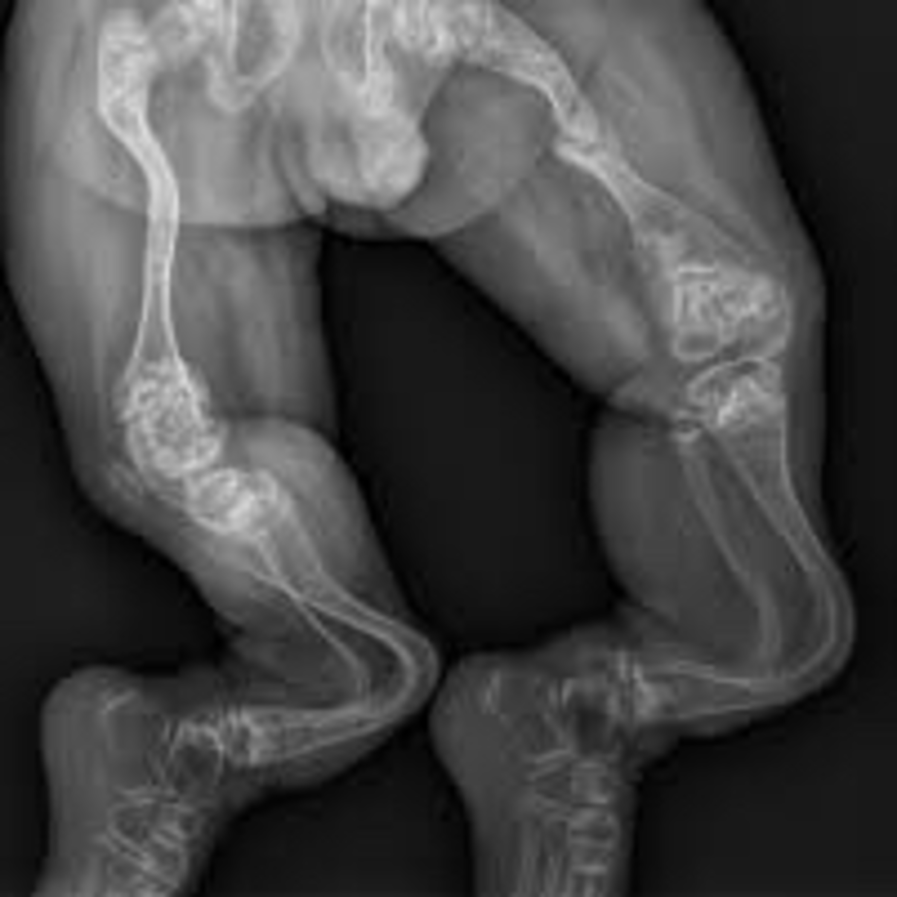 OSTEOGÉNESIS IMPERFECTA/Marta Delgado/Podcast 3 Tercer trimestre