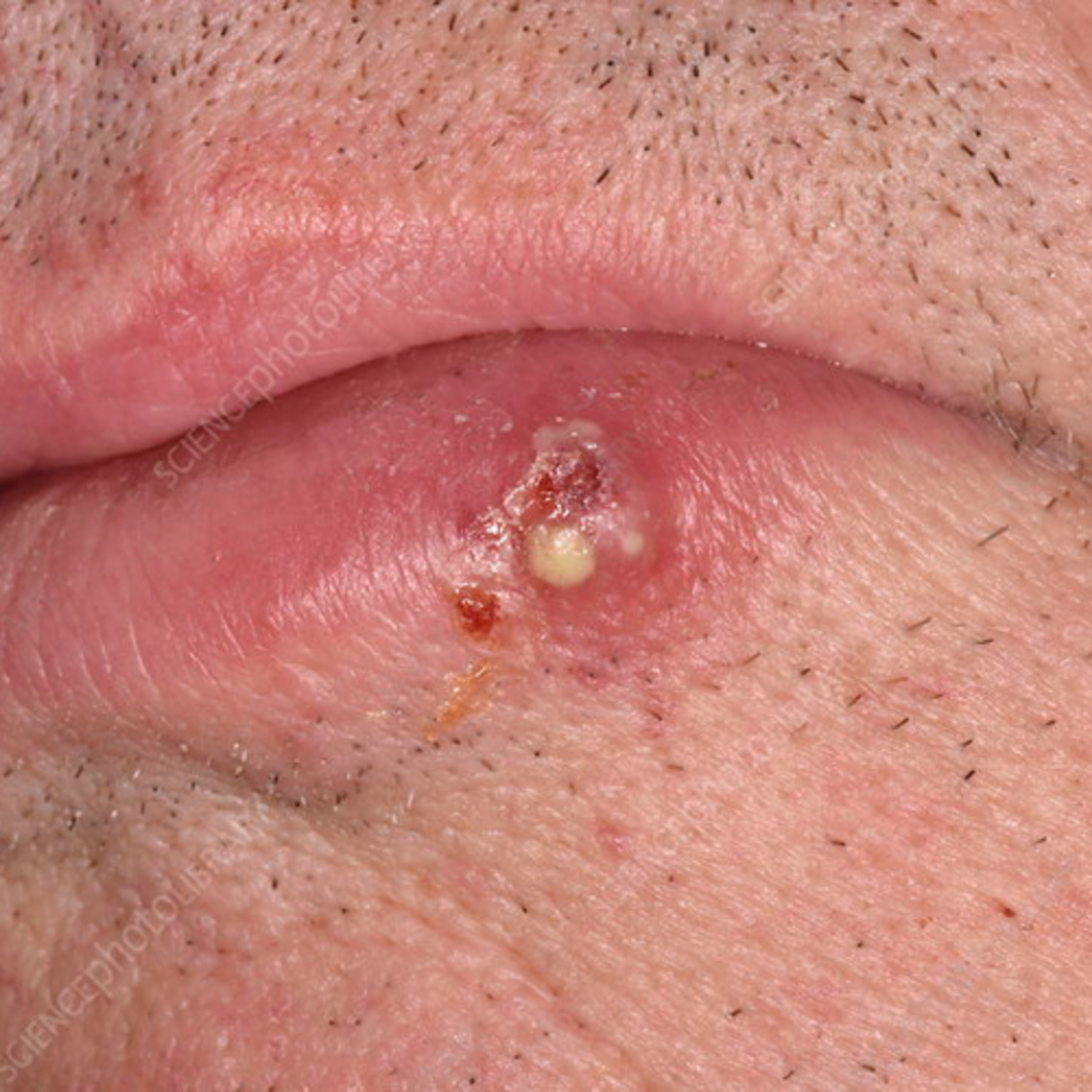 “What are 3 Key Clinical Features of Oral Basal Cell Carcinoma?” - Quick Read #29, 6.26.23 episode artwork