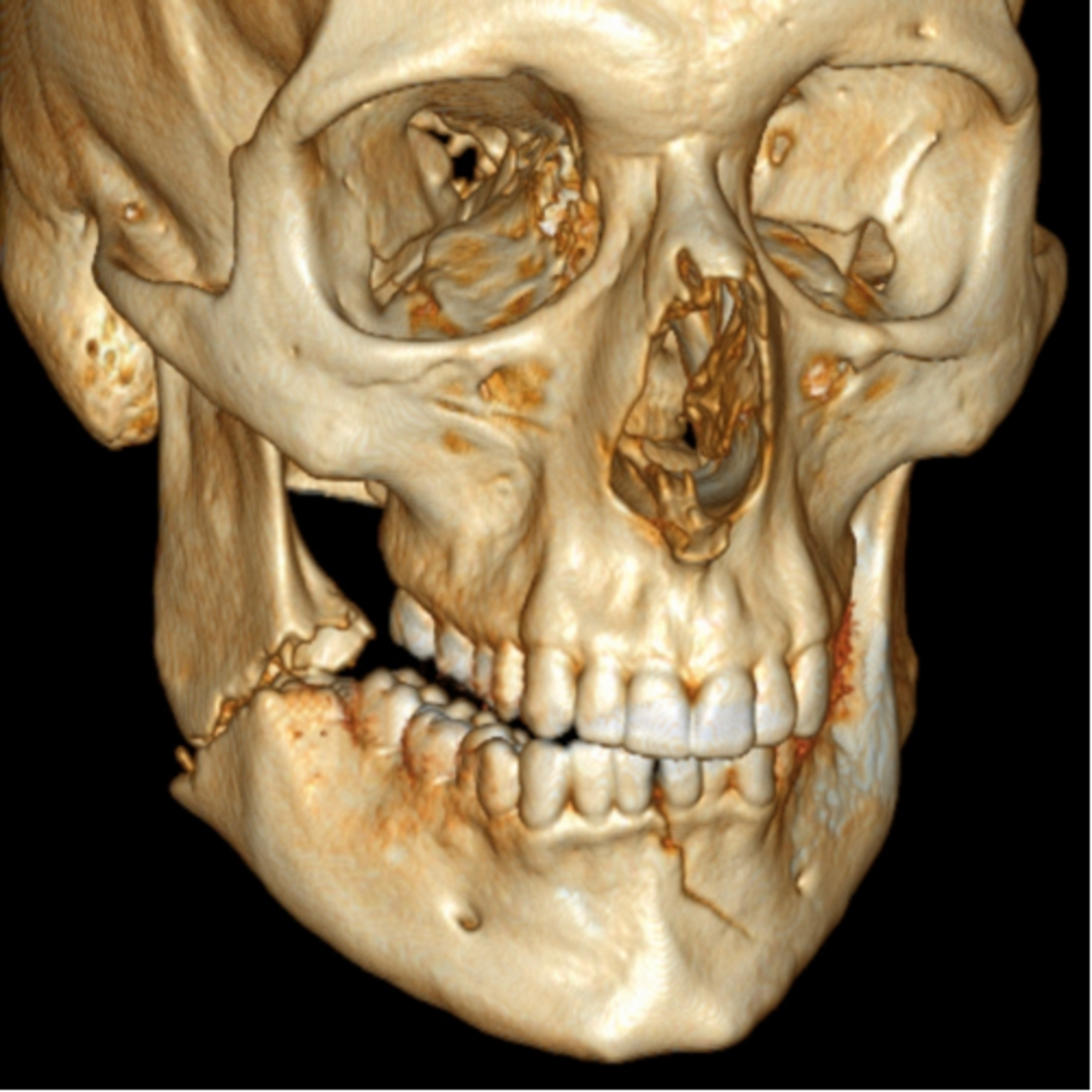 “What are Important Evaluations during Clinical Assessment of a Facial Fracture?” - Quick Read #30 episode artwork