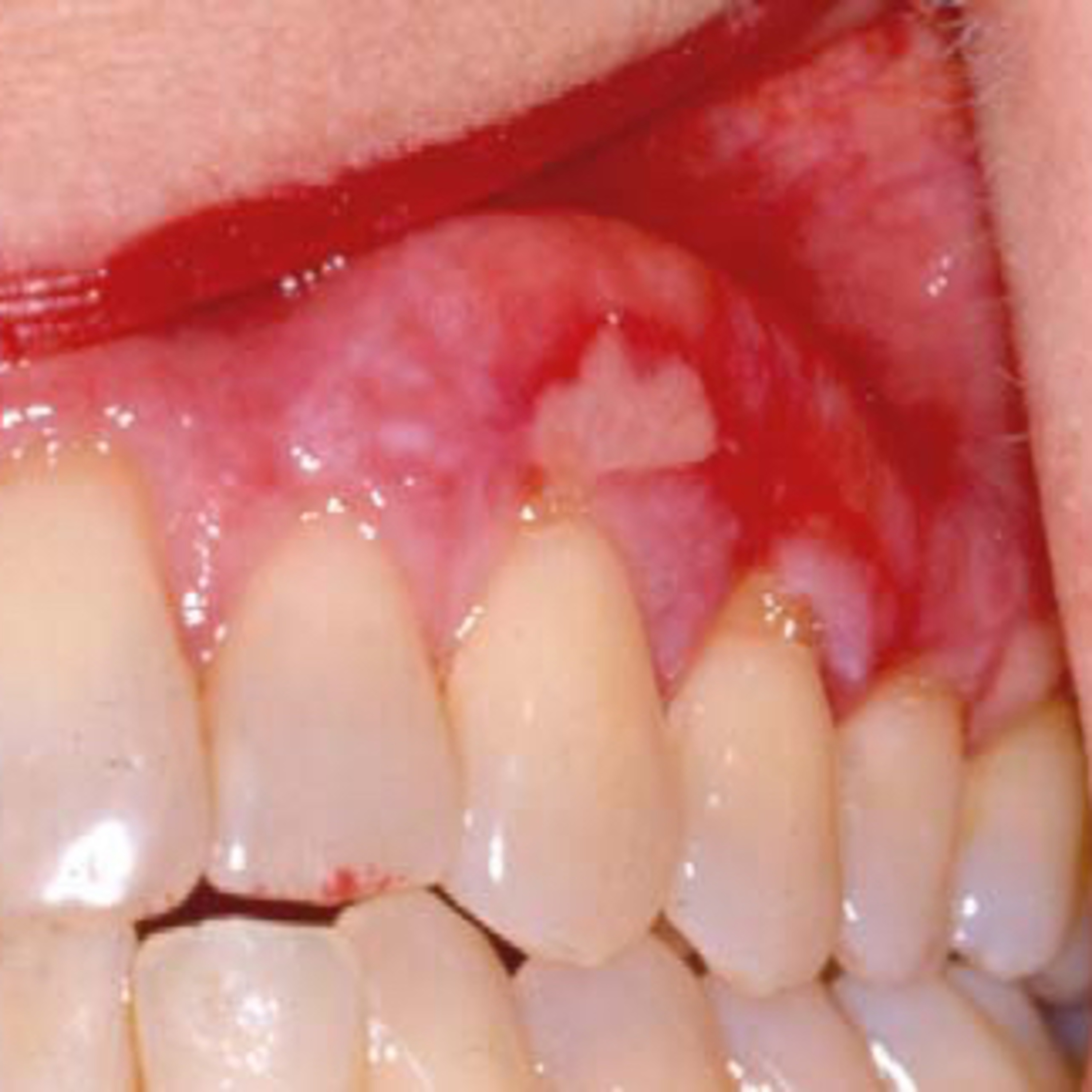 “What are 3 Key Oral Manifestations of Erosive Lichen Planus?” - Quick Read #36, 7.9.23 episode artwork