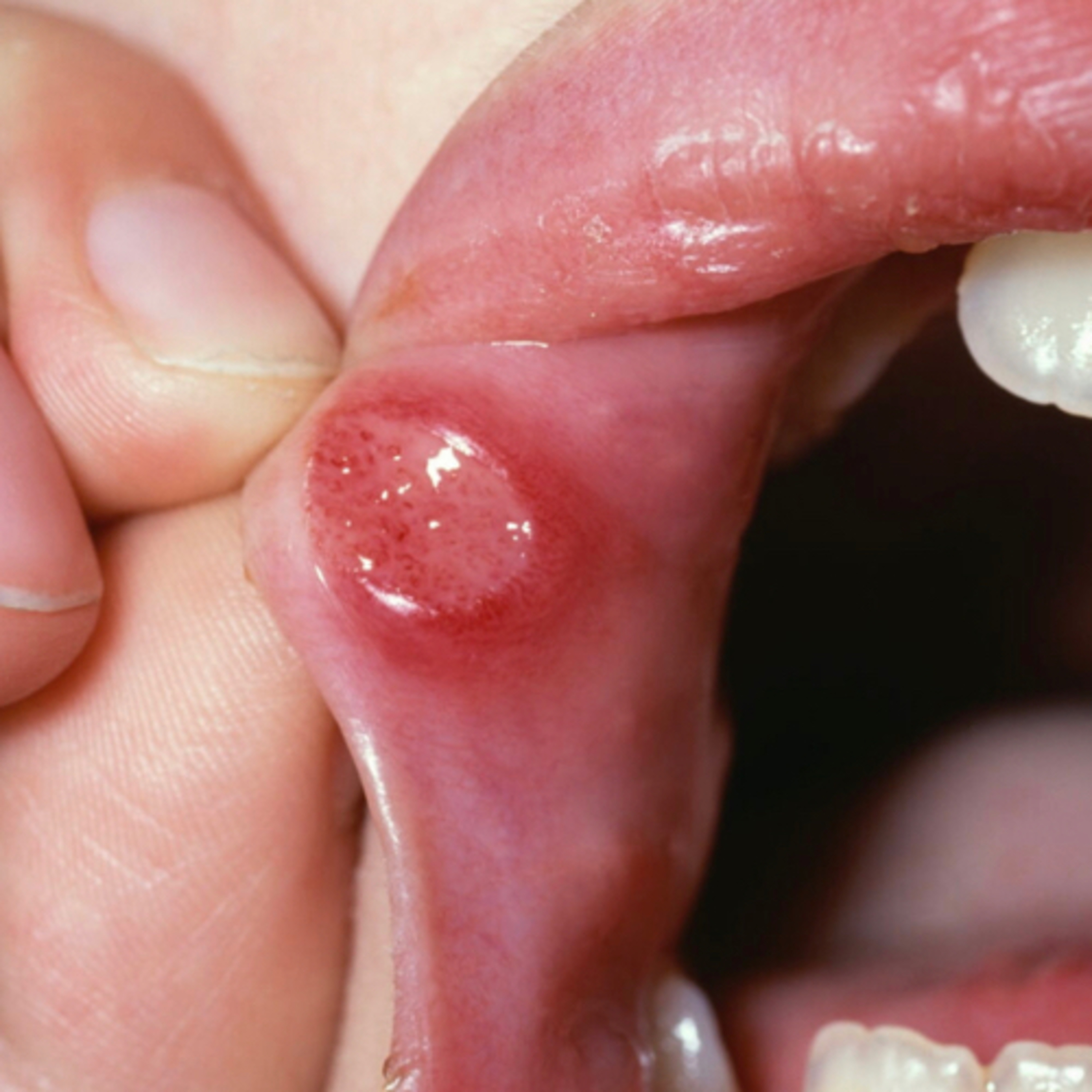 “What are Key Features that Differentiate Aphthous Stomatitis from oral Crohn’s Disease?” - QR #38 episode artwork