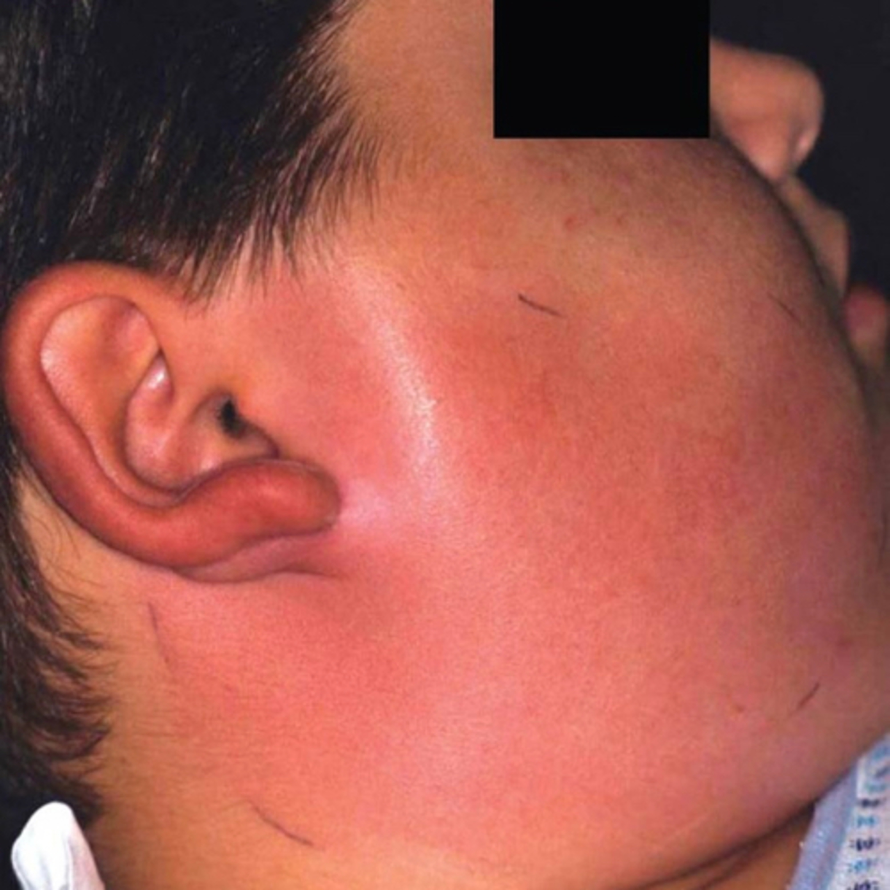 “What is ‘Indurated’ Facial Swelling, and When Related to an Odontogenic Abscess?” episode artwork
