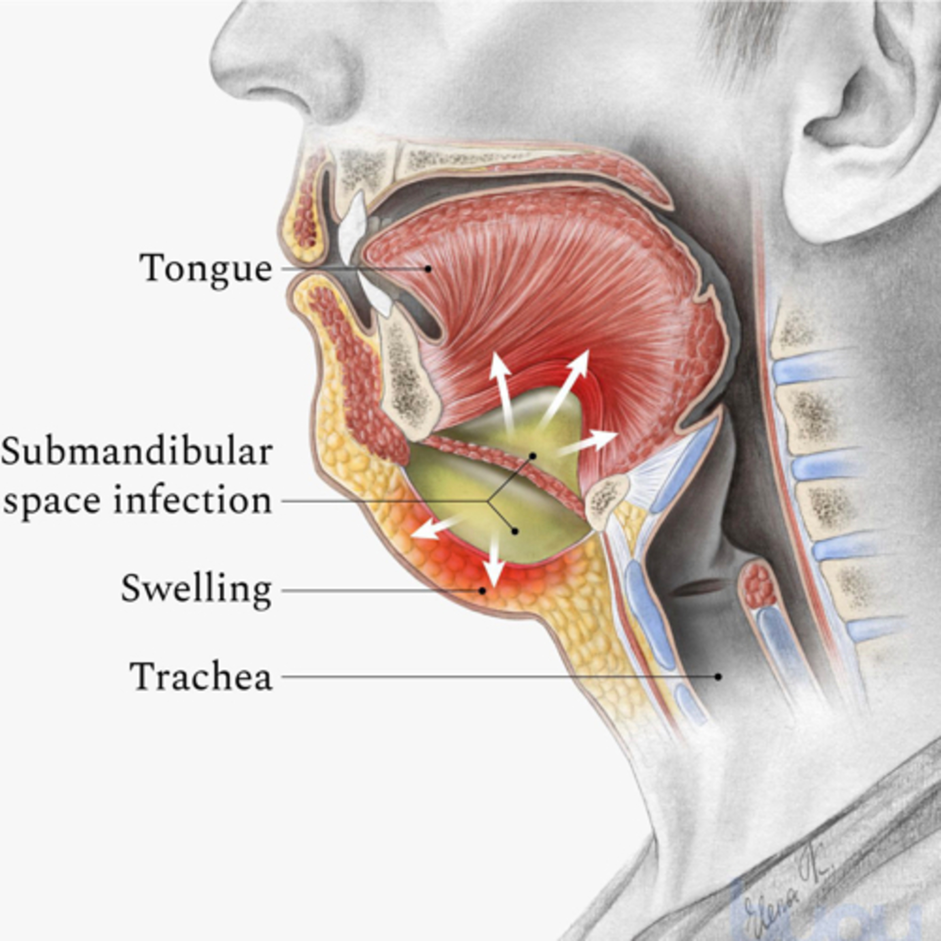 “What are Key Clinical Features of Ludwig’s Angina?” episode artwork