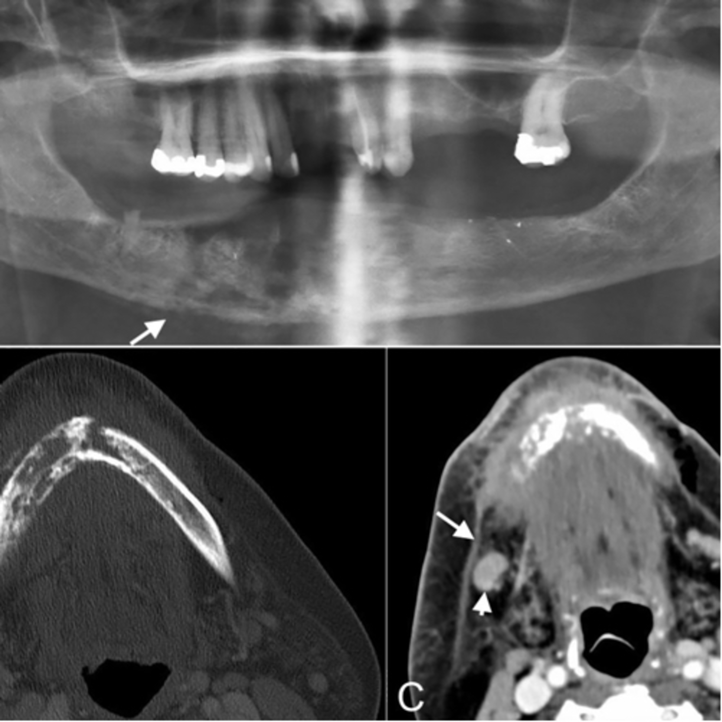 “What are Key Risk Factors for Osteomyelitis and Osteonecrosis of the Jaw?” episode artwork