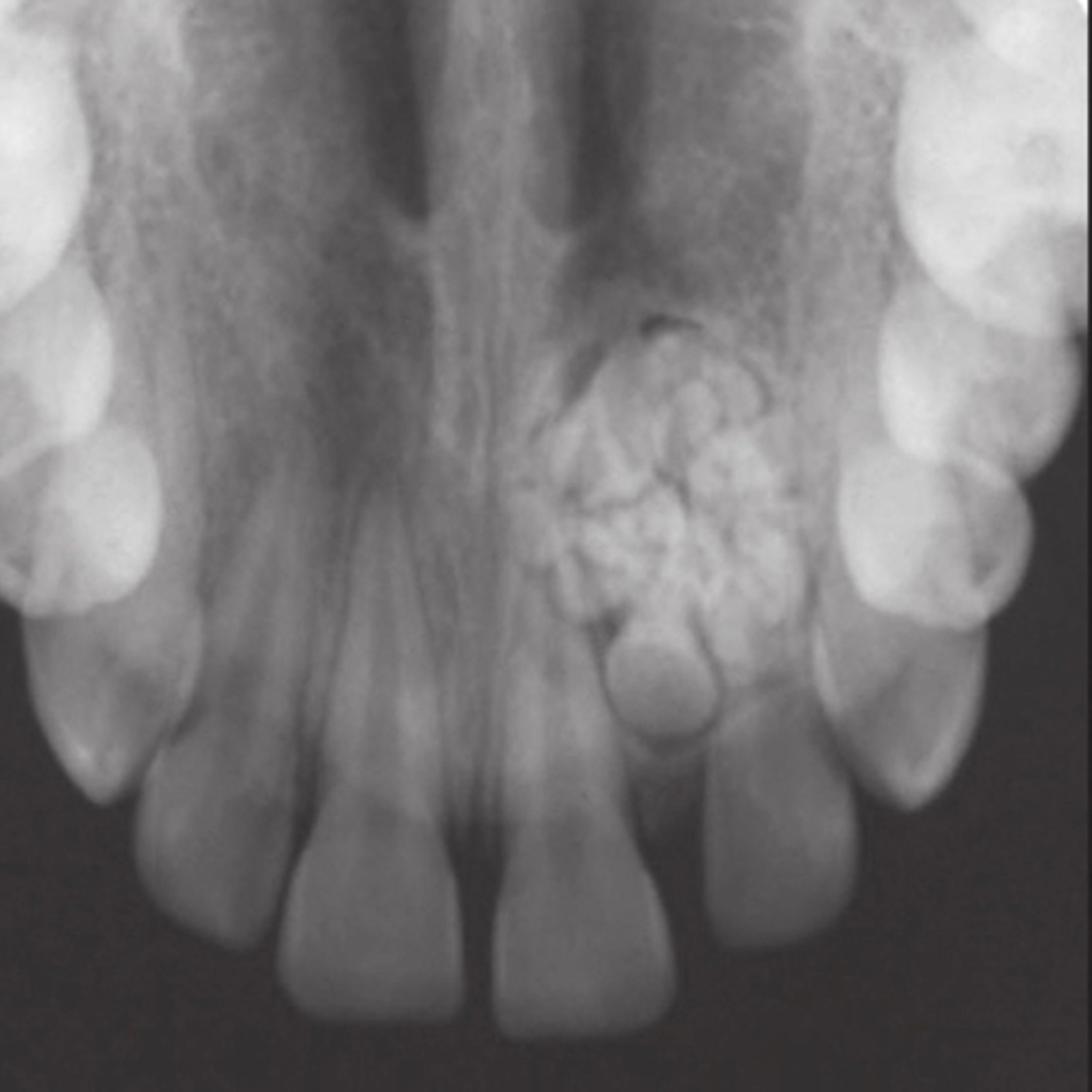 “What are Key Distinguishing Features of the Compound vs. Complex Odontoma?” episode artwork