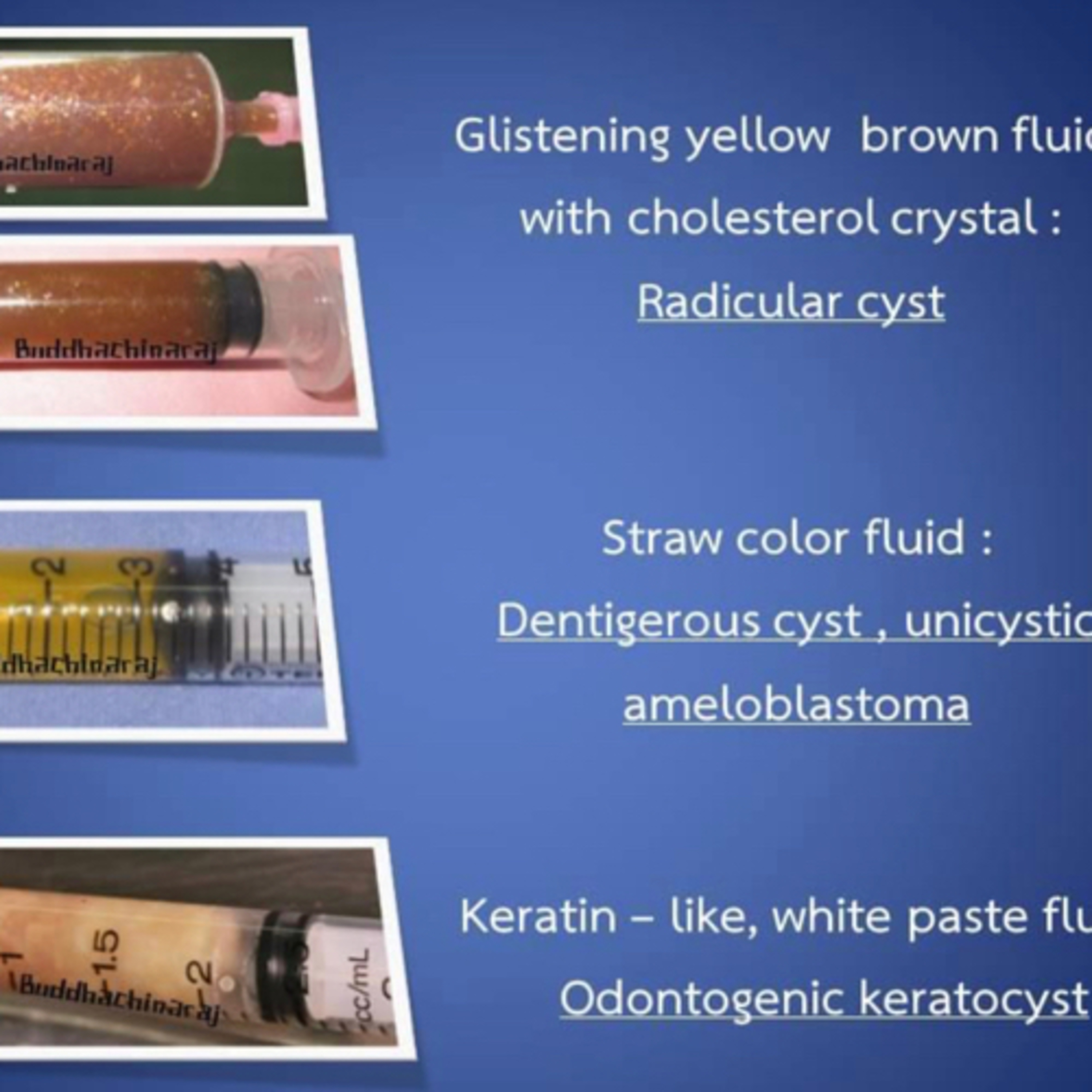 “What Cystic Contents Differ Between the Dentigerous Cyst, Radicular Cyst, Odontogenic Keratocyst?”