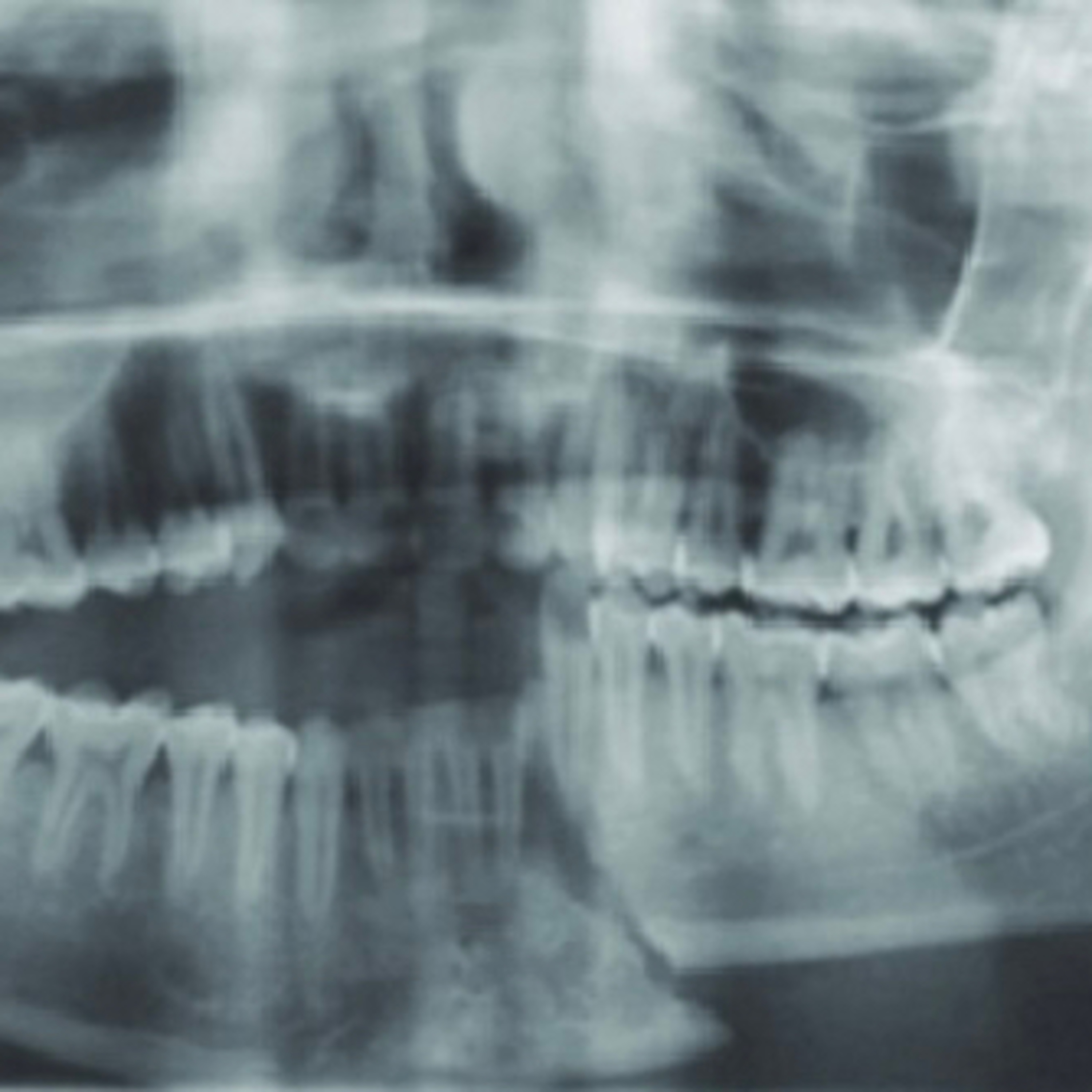 “What Steps are Involved in Repairing a Displaced Parasymphysis Fracture of the Mandible?” episode artwork