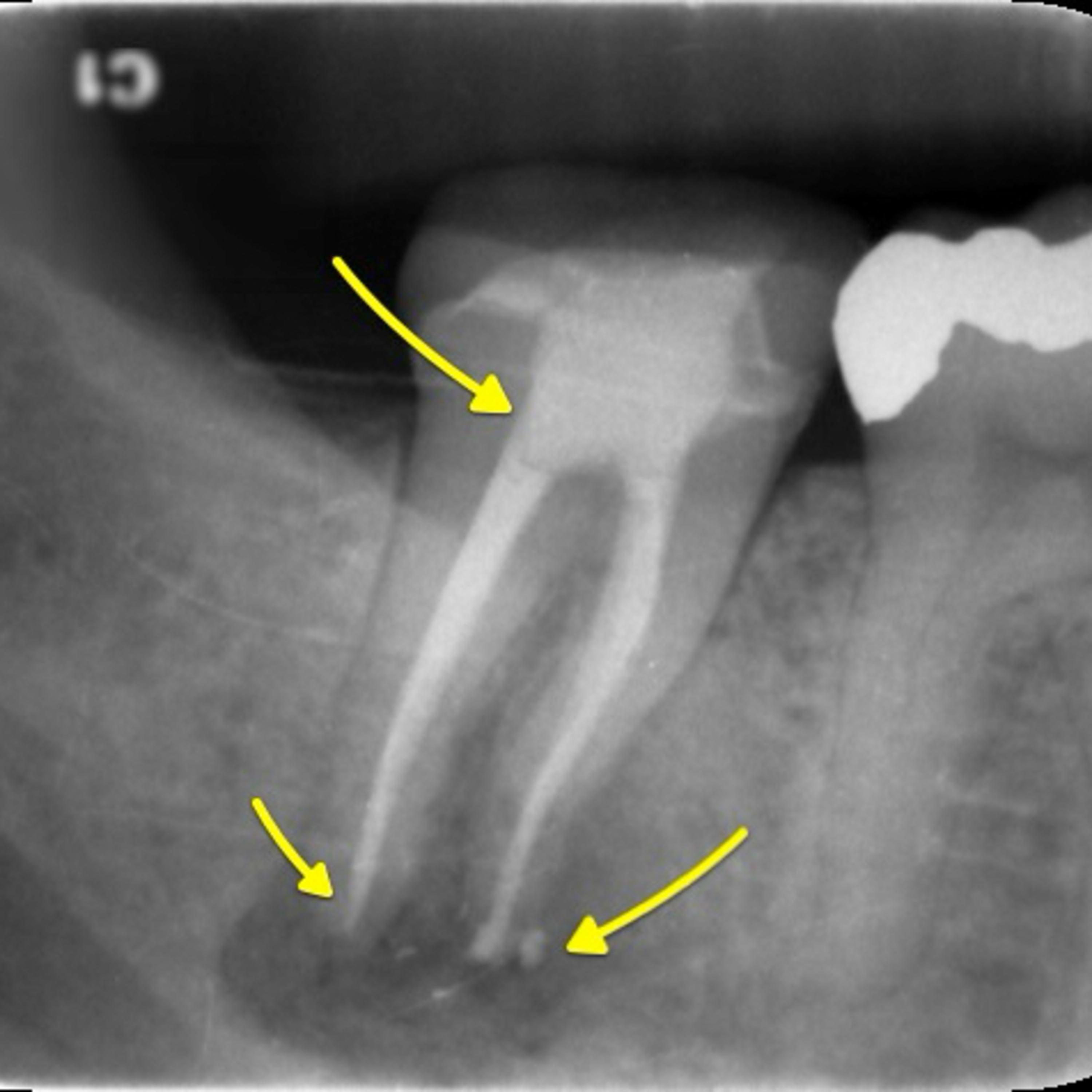 “What are the Rates of Success vs. Failures of Root Canal Retreatment?” - Quick Review #75 episode artwork