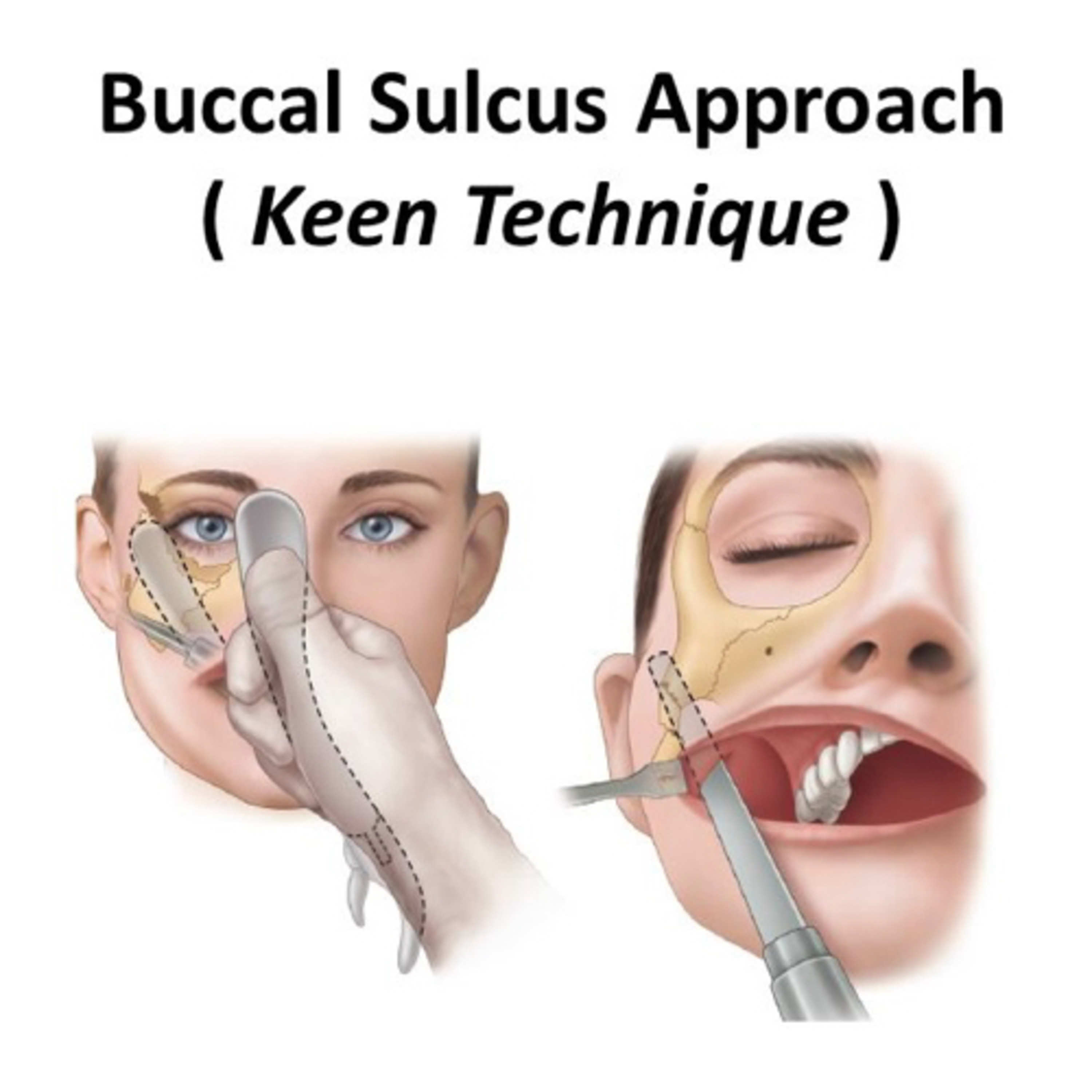 “What are the Pros & Cons of Gillies vs Keen (Intraoral) Approaches to Zygomatic Arch Reduction?” episode artwork