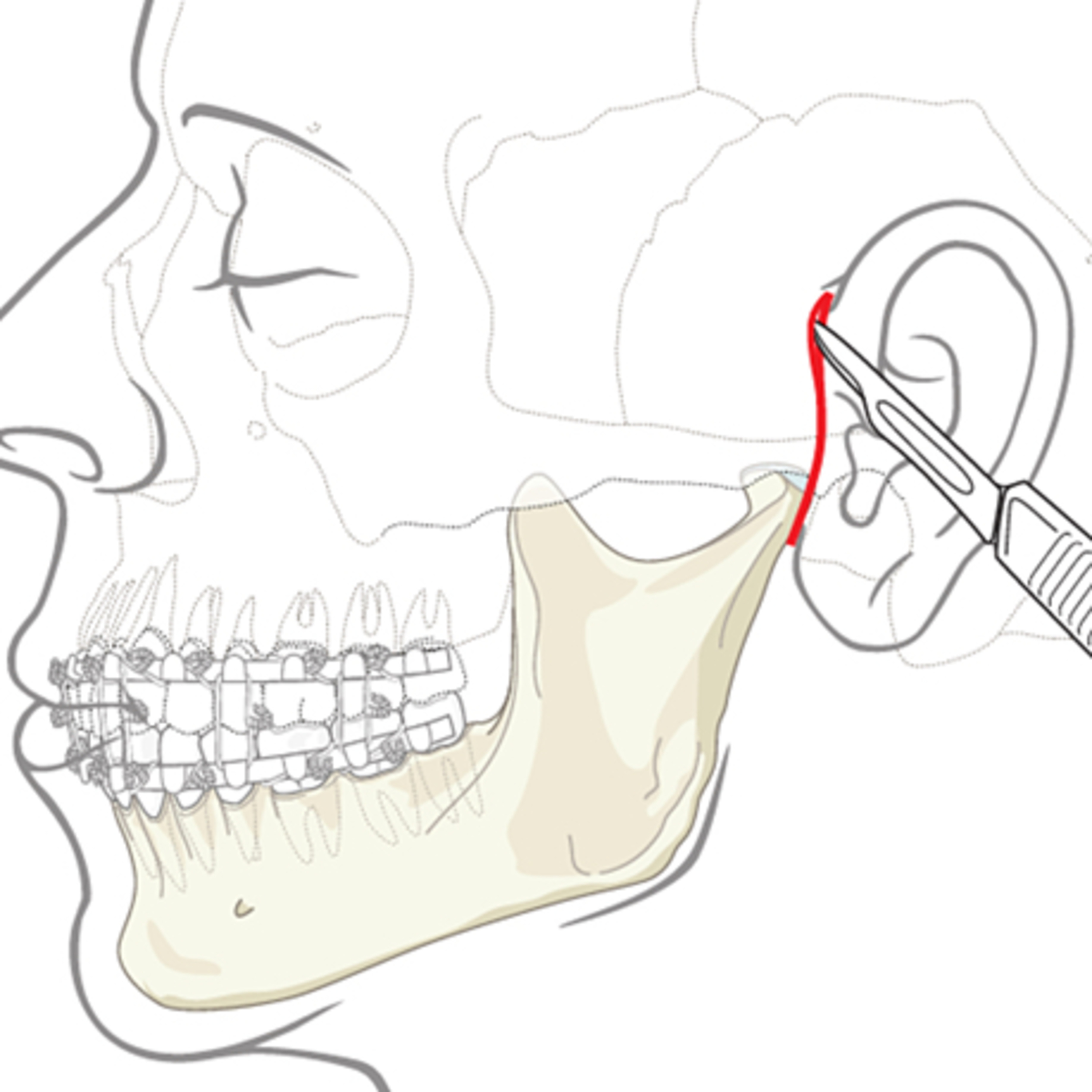 “What are the Preauricular Incision Indications, Design, Pros vs. Cons?” episode artwork