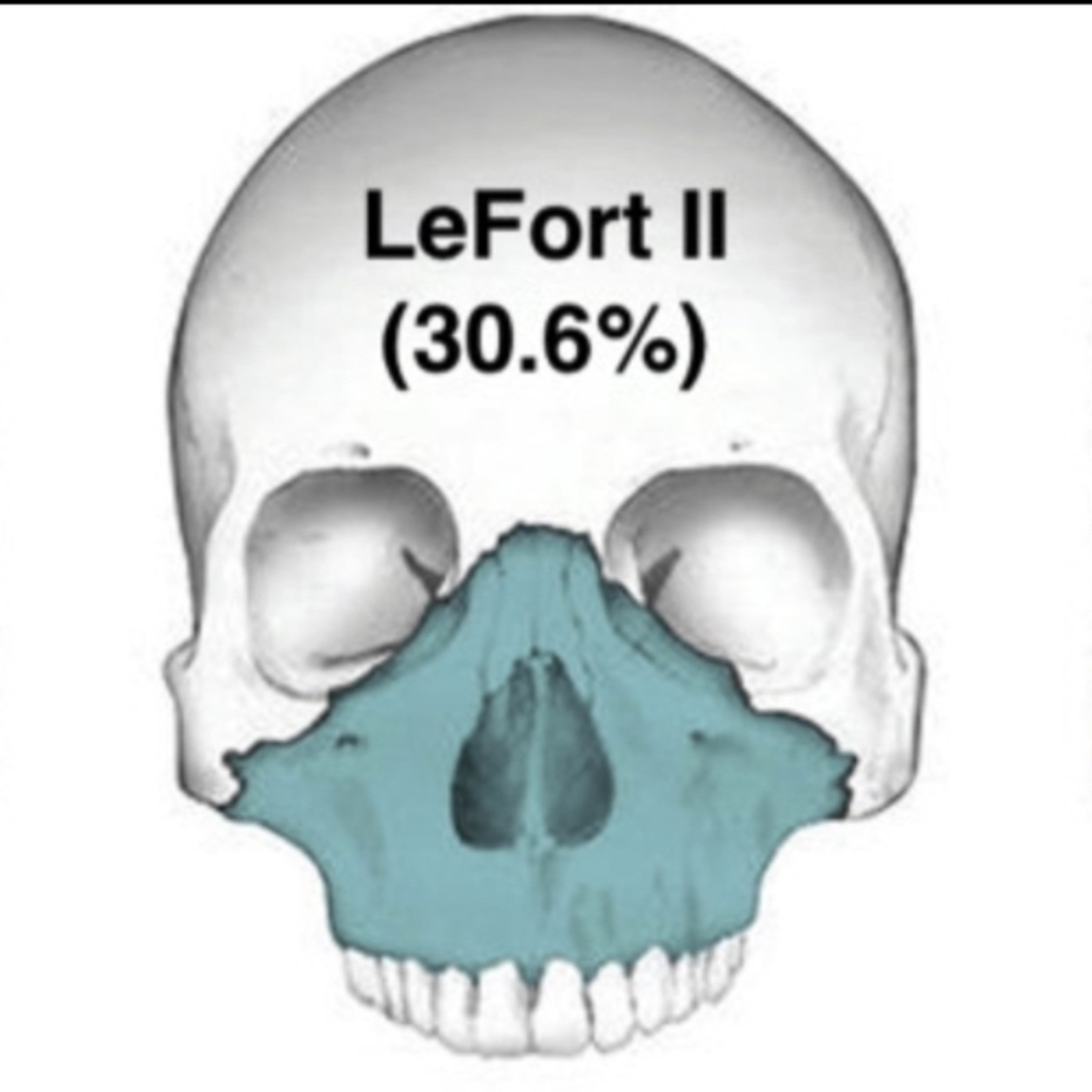 “What are the 3 LeFort Fracture Types?” episode artwork