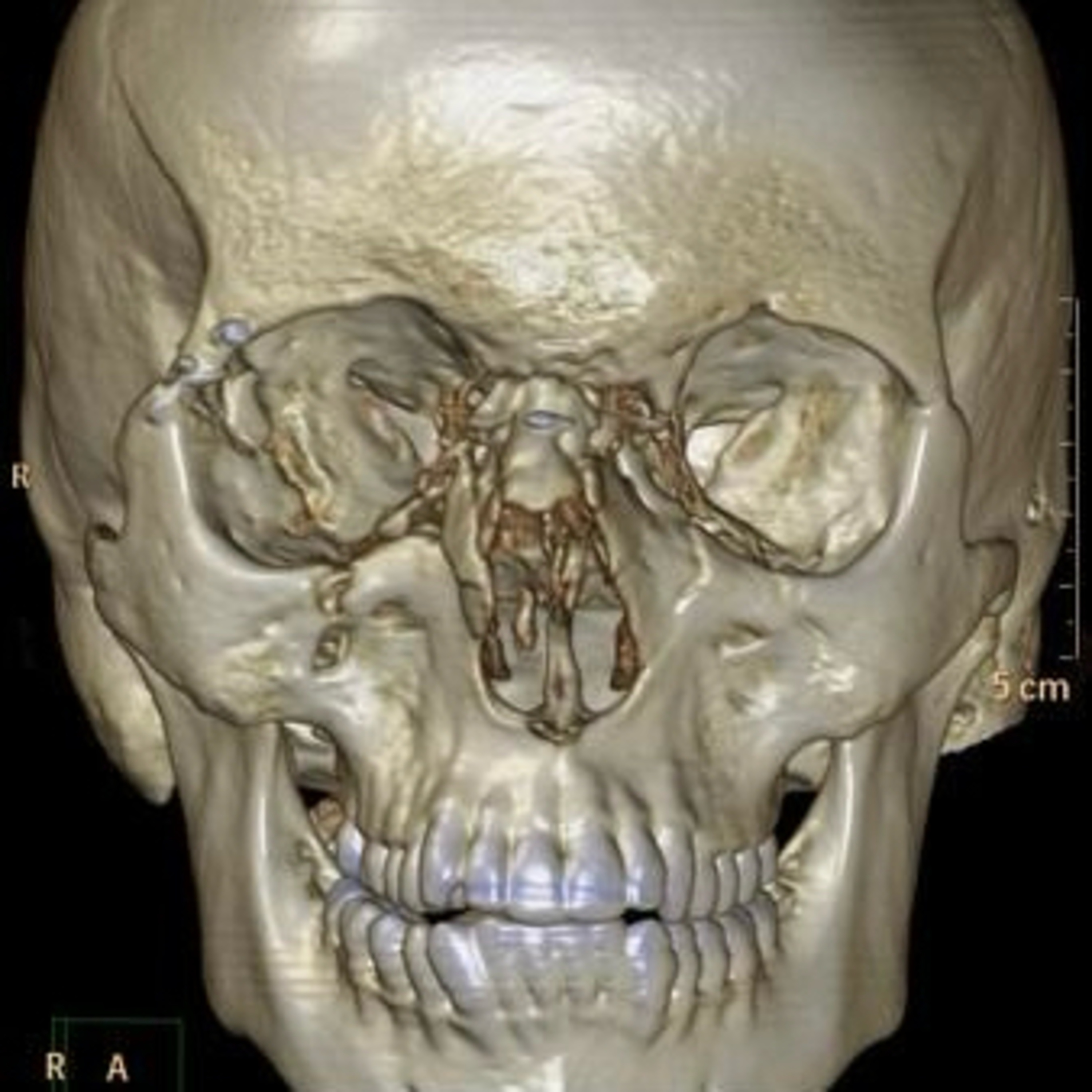 “How To Diagnose NOE (Nasoethmoidal) Fractures?” episode artwork