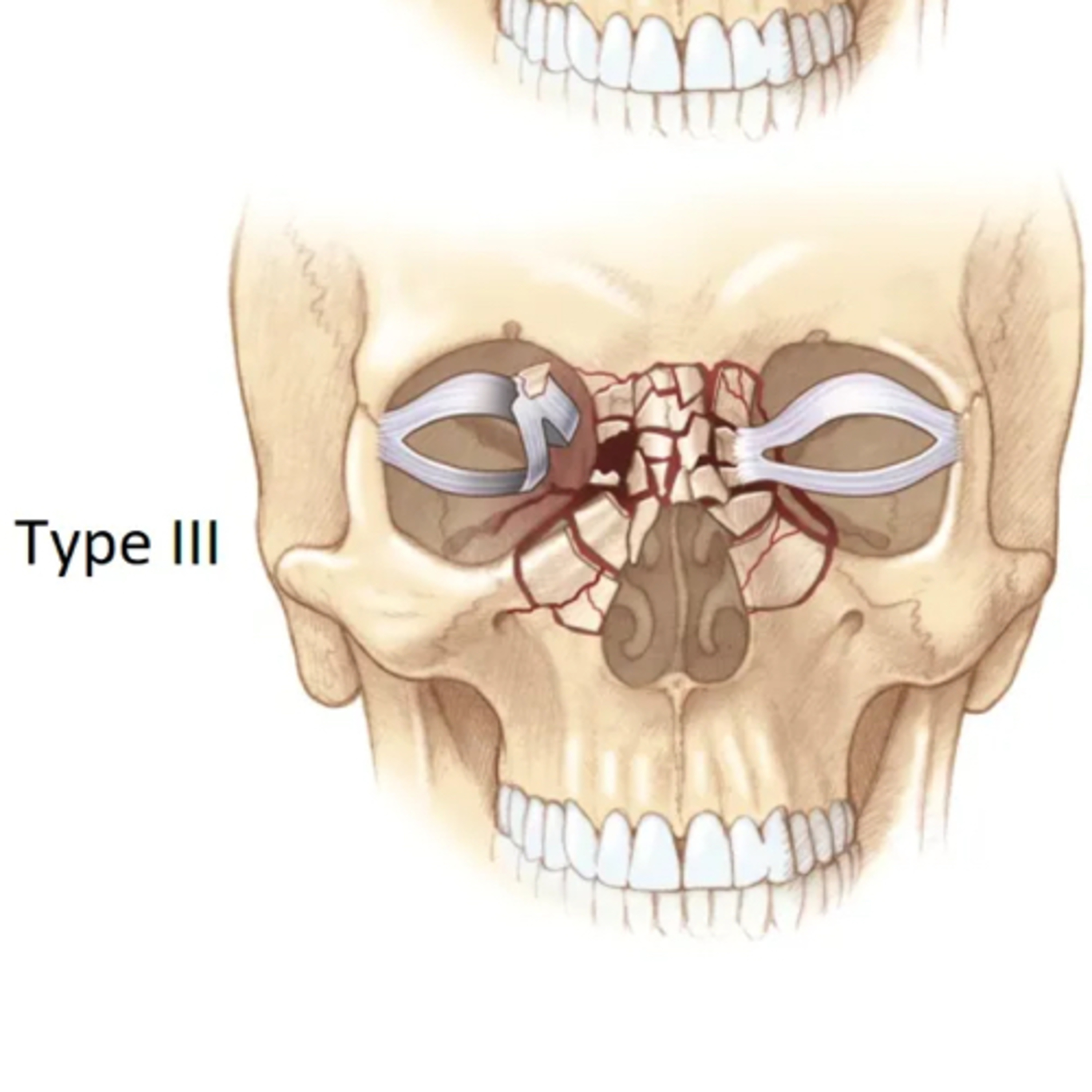 “What are the Types of NOE (Naso-orbitoethmoid) Fractures and How To Repair Them?” episode artwork