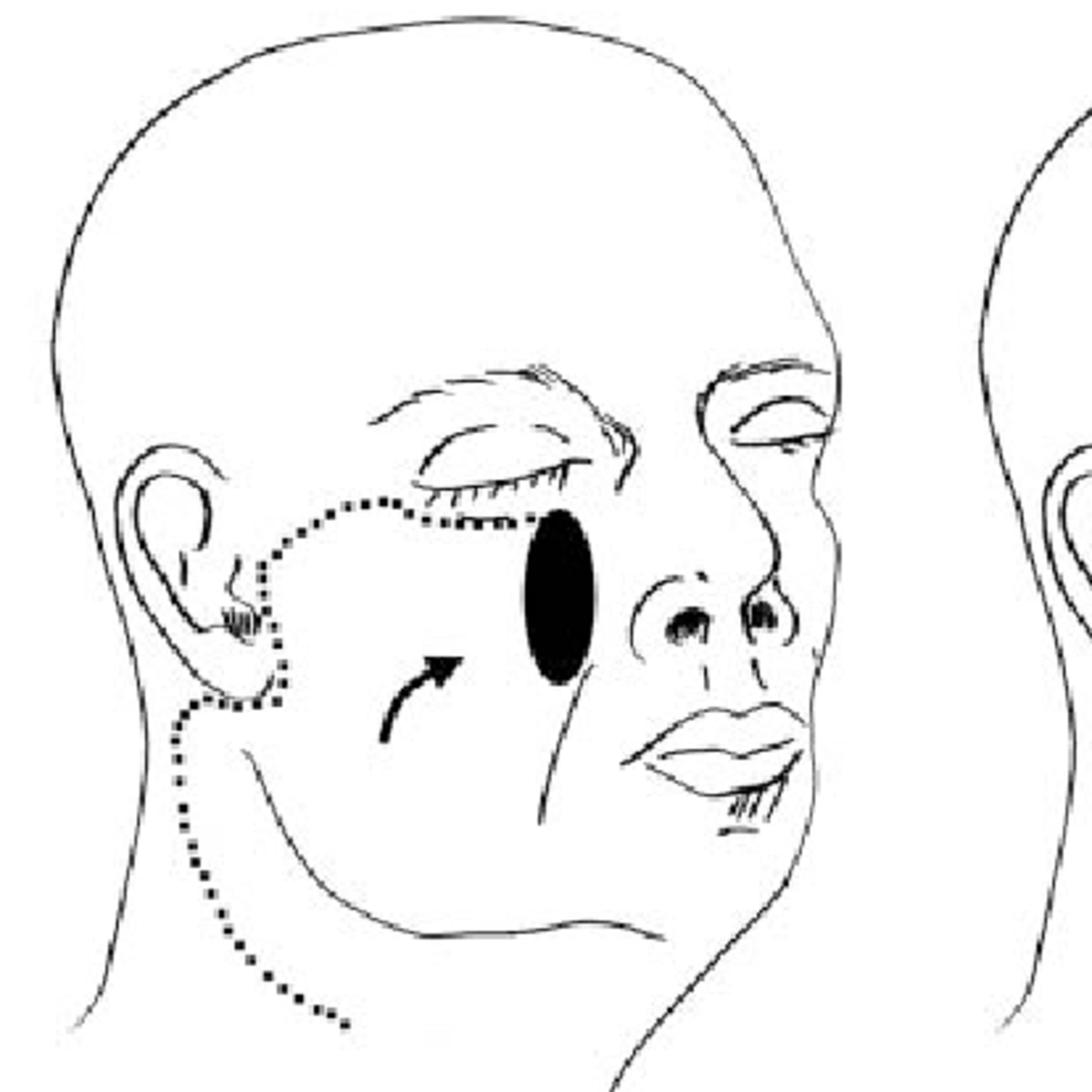 “What is a Cervicofacial Advancement Flap?” episode artwork