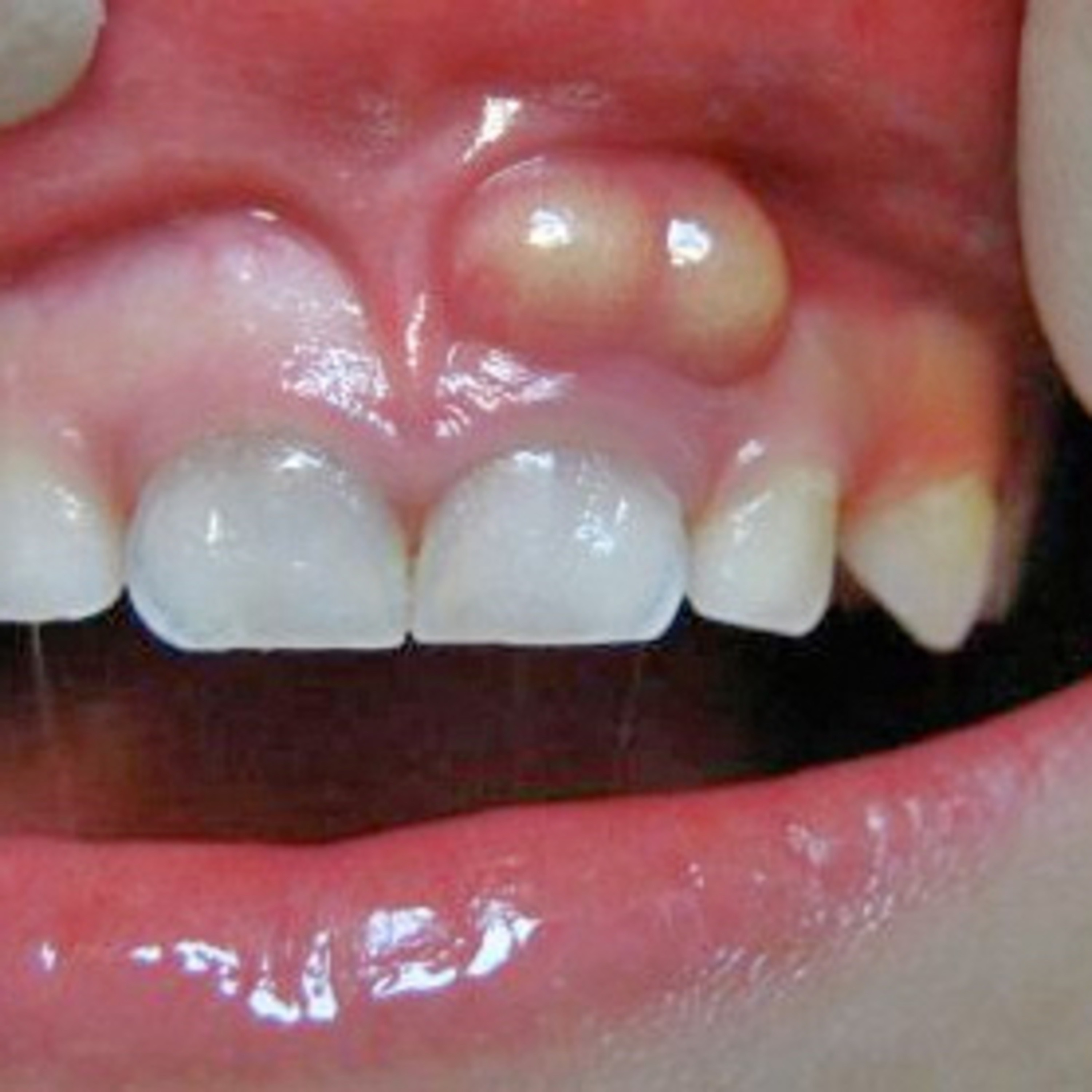 “What is the Difference Between Acute vs. Chronic Dental Infections?” episode artwork